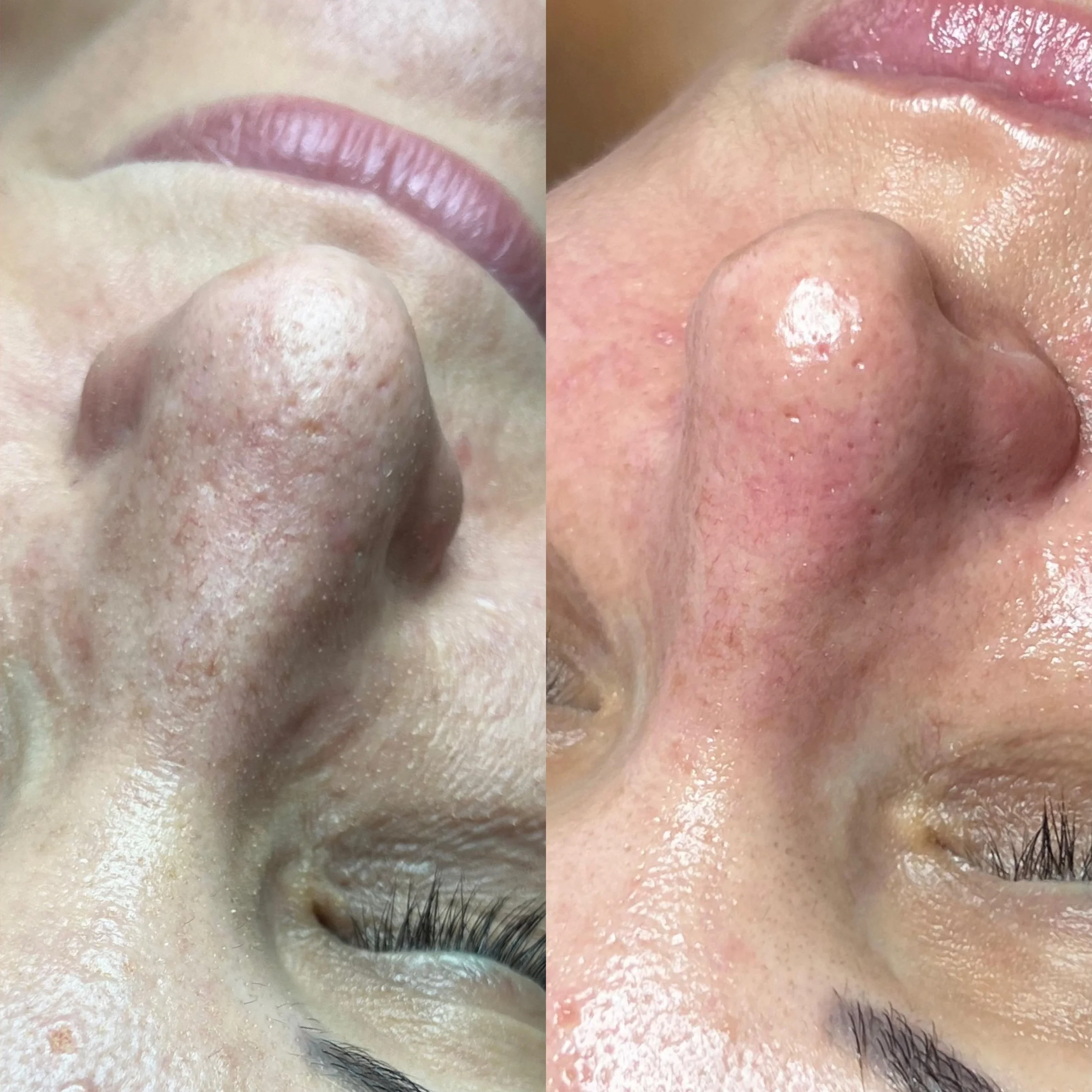 blackhead extractions facial