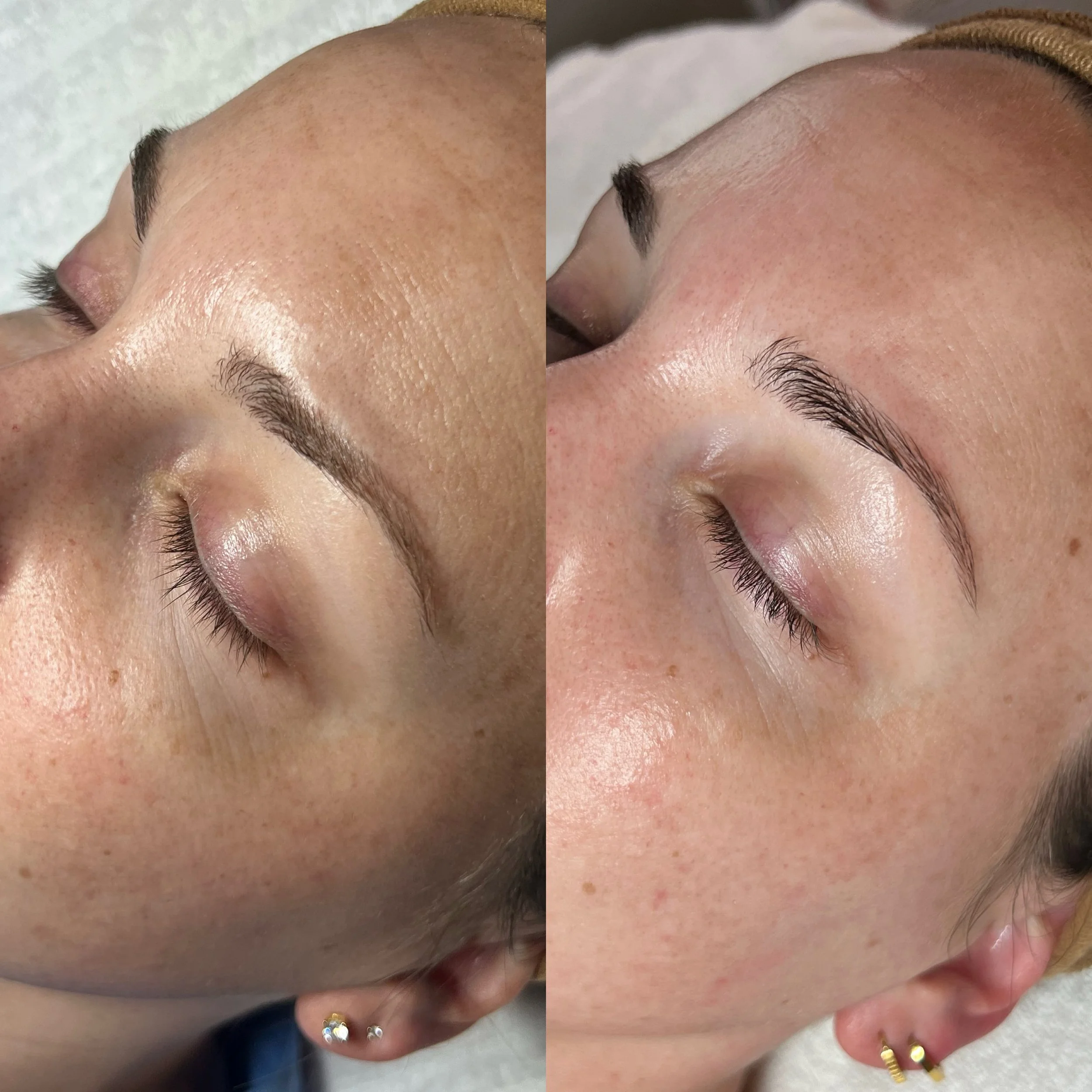 sun damage chemical peel