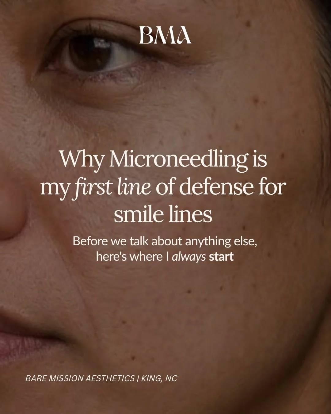 Microneedling + a professionally structured skincare routine = you loving your skin. (Maybe a dash of Botox too) 😉

My love for this treatment goes deep. I&rsquo;ve seen it improve deep acne scars, sun damage, stubborn closed comedones, countless wr
