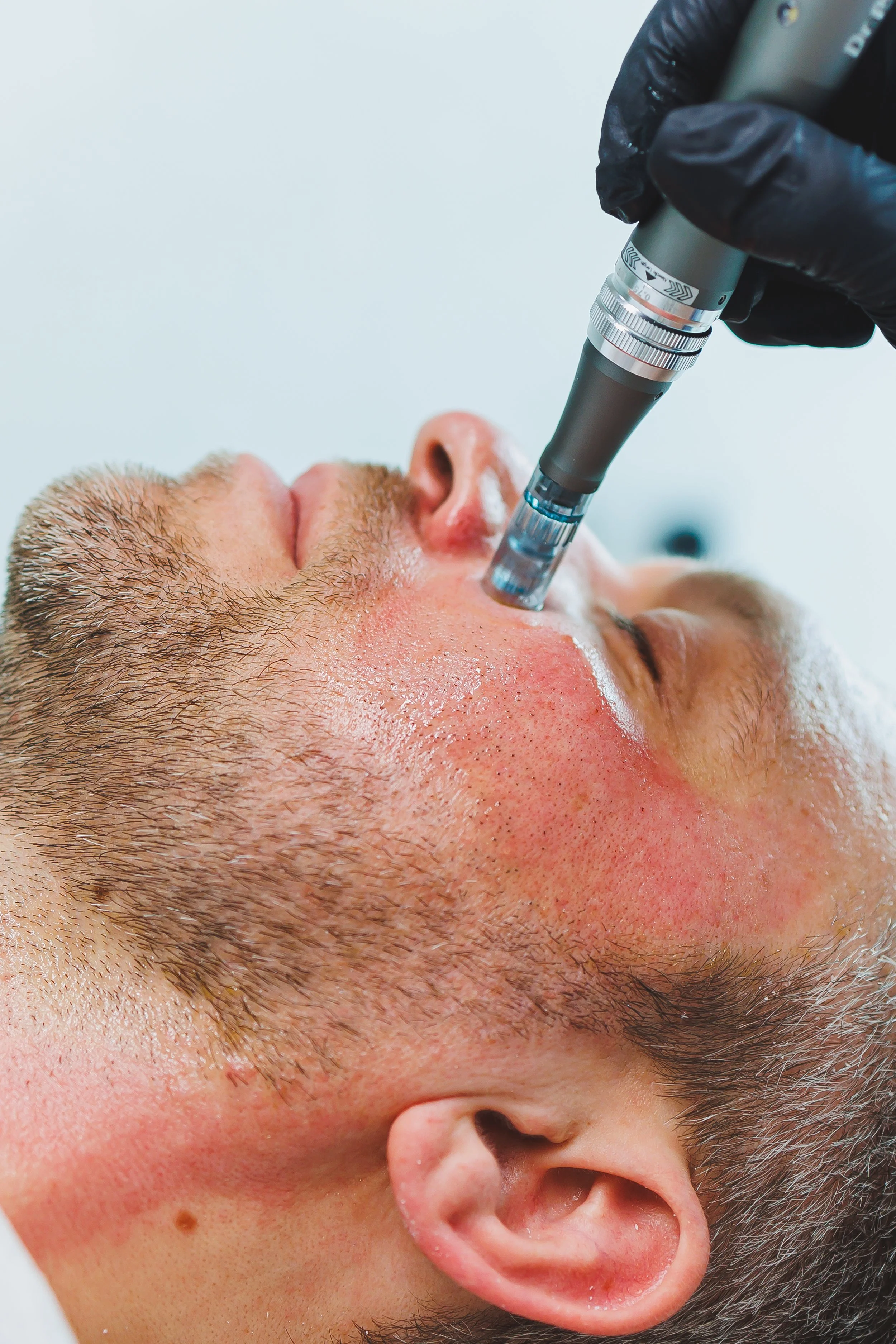 microneedling king nc