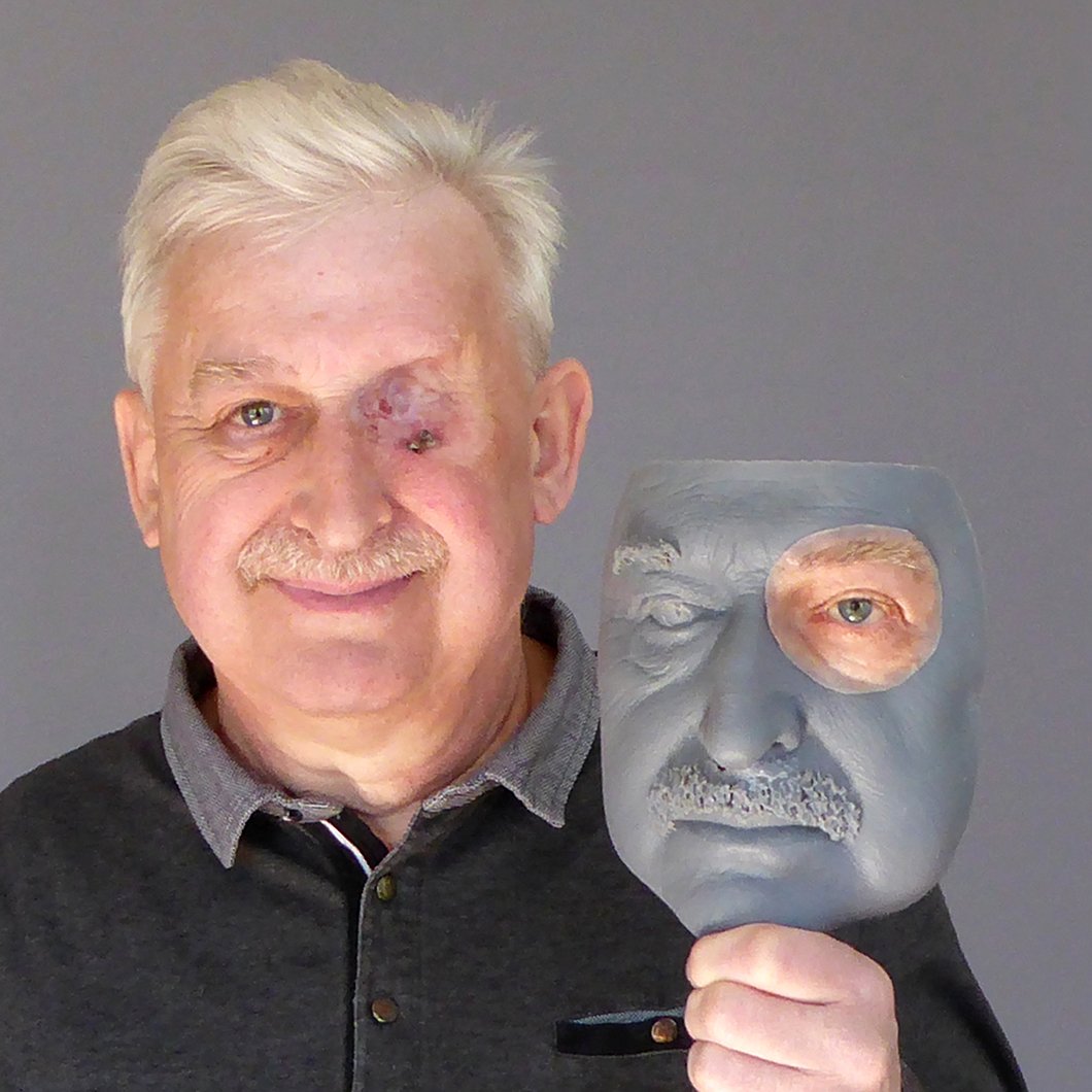 René-Pierre holding his 3-D mask with his epithesis