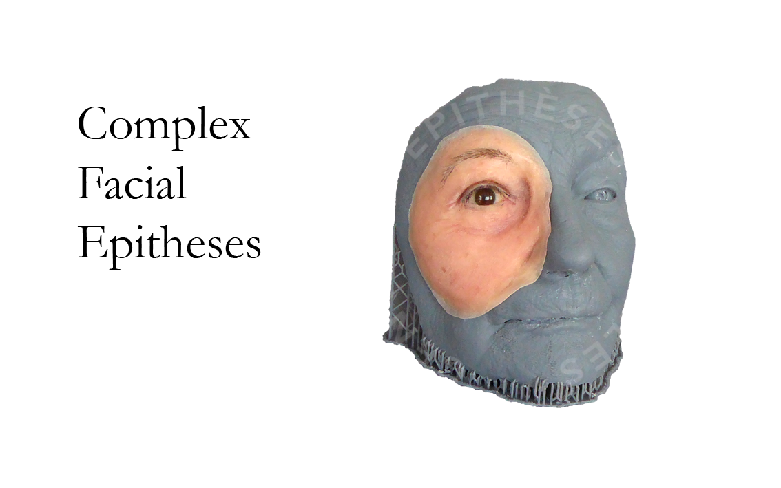 Complex Facial Epitheses