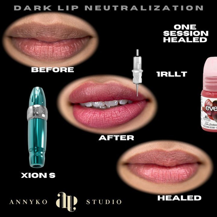 Lip neutralization New York 
first session healed result 🙌
@microbeauofficial @siciliano.lulu 

Dark Lip Neutralization is a process that takes time, but the end result is completely worth it! 

After your first session, you&rsquo;ll see some lighte