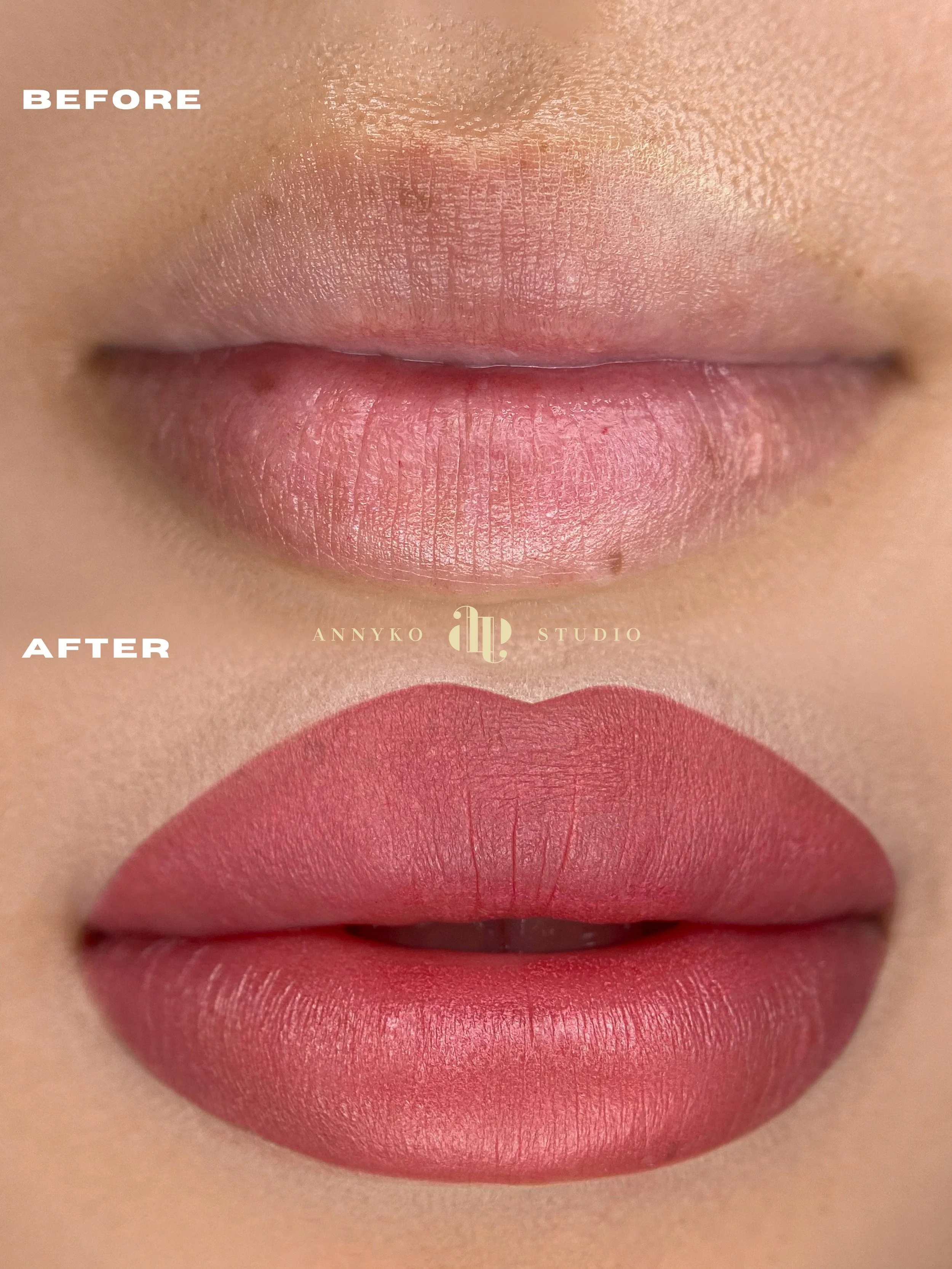 Natural Beauty, Enhanced: Choosing the Right Lip Treatment