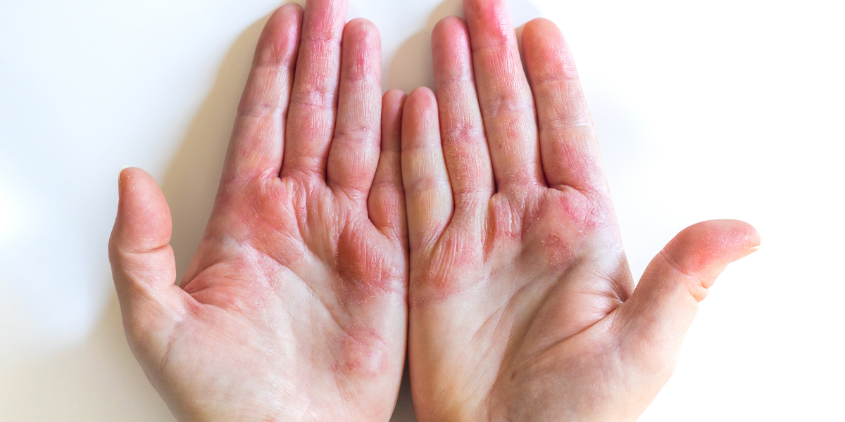 Eczema Starting in the Gut? What Intestinal Permeability + Stool Testing Can Reveal