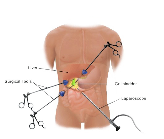 laparoscopic gallbladder surgery diagram