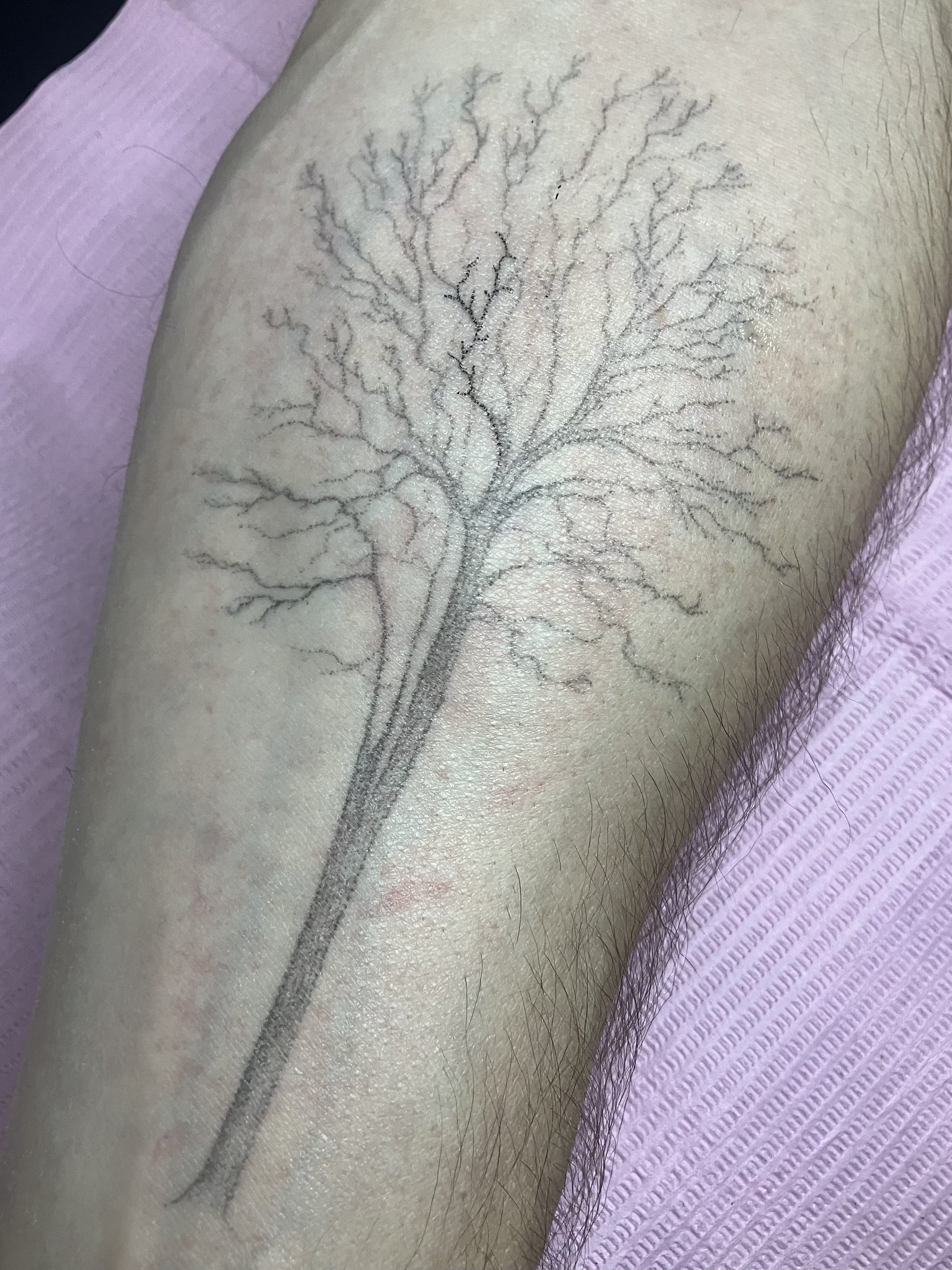 ~1 year healed