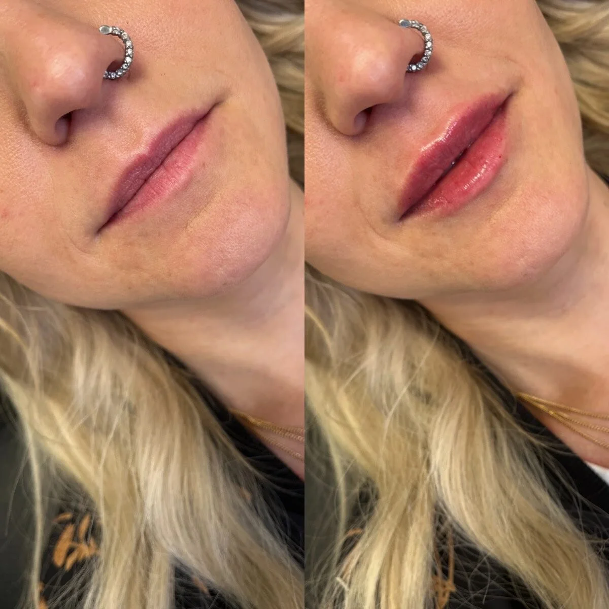 LIPS
π Product - 1/2 syringe - Restylane Kysse
π³ Pain level - 3/10 with numbing cream
β° Length of appointment - 30-45 minutes
β¨ Duration of product - 6-9 months
π Common side effects - bruising, swelling, discomfort 
πLocation - Franks by Frida