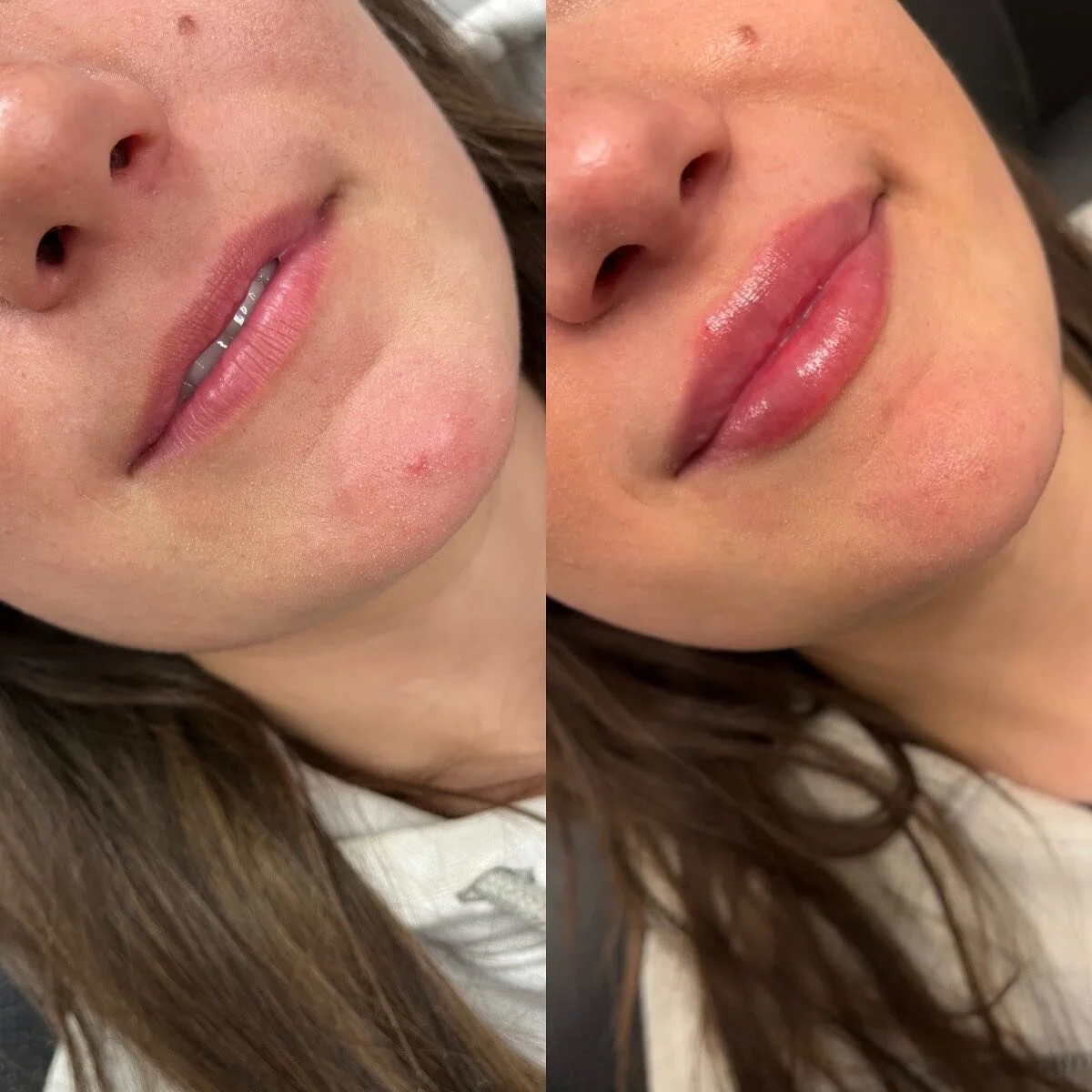 We’ve been slowly filling this babes lips, half syringe at a time over the last year. 1.5 syringes total. Slow and steady wins the race π 
π Product - 1.5 syringes 
π³ Pain level - 3/10 with numbing cream
β° Length of appointment - 30-45 minu