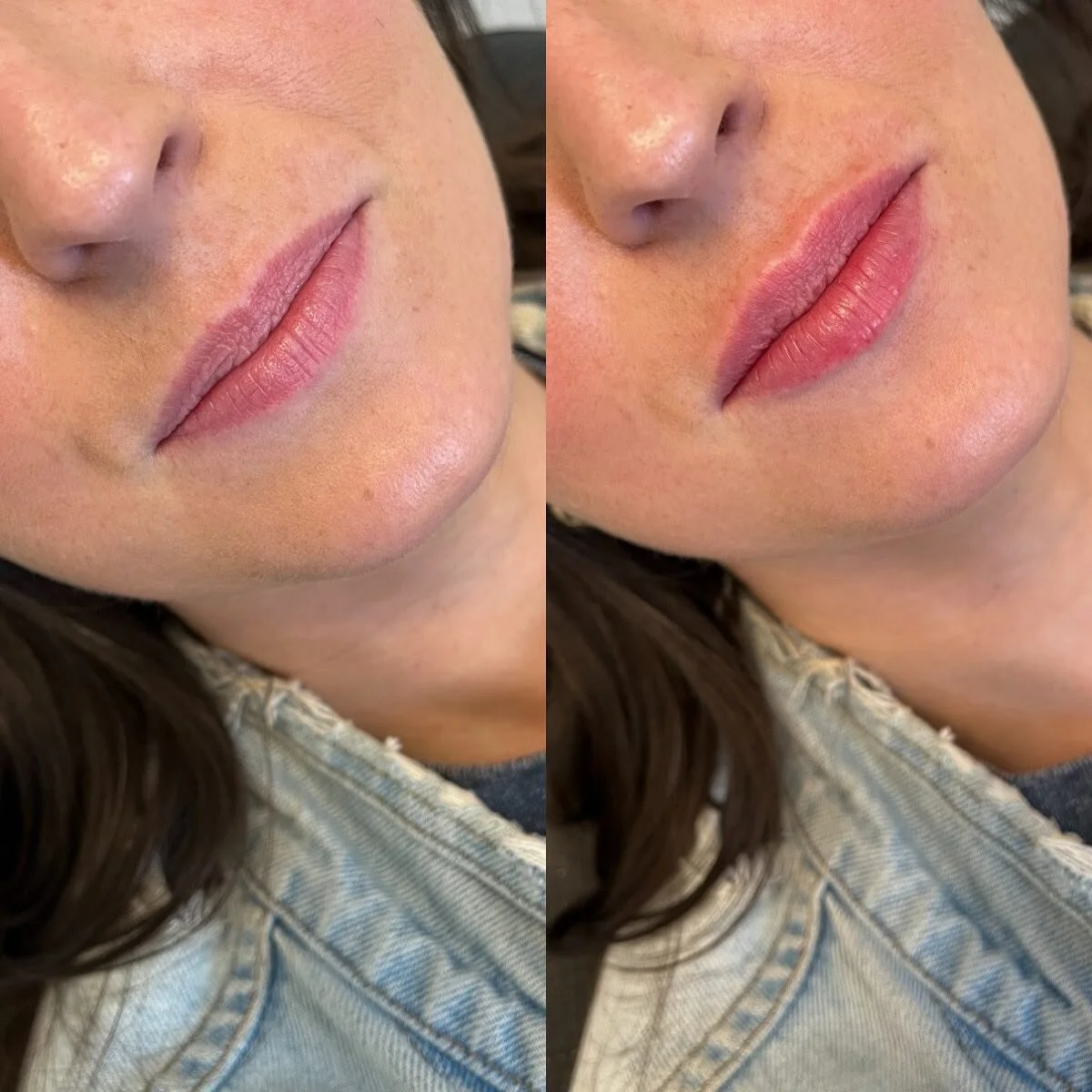 Keeping it super natural and subtle for this babe by adding just a small amount of filler to create a more “hydrated” appearance π 
LIPS
π Product - 1/2 syringe - Restylane Kysse
π³ Pain level - 3/10 with numbing cream
β° Length of app