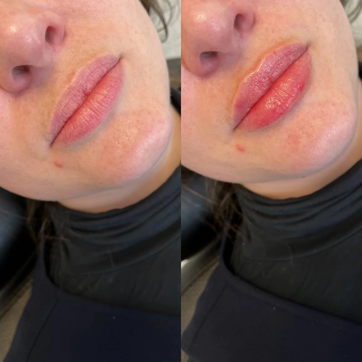 LIPS
π Product - 1/2 syringe - Restylane Kysse
π³ Pain level - 3/10 with numbing cream
β° Length of appointment - 30-45 minutes
β¨ Duration of product - 6-9 months
π Common side effects - bruising, swelling, discomfort 
πLocation - Franks by Frida