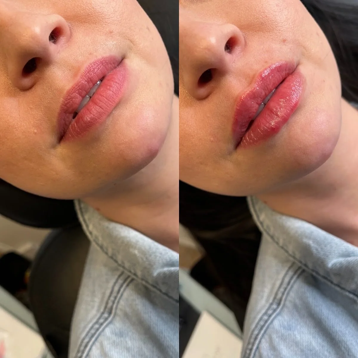 LIPS
π Product - 1/2 syringe - Restylane Kysse
π³ Pain level - 3/10 with numbing cream
β° Length of appointment - 30-45 minutes
β¨ Duration of product - 6-9 months
π Common side effects - bruising, swelling, discomfort 
πLocation - Franks by Frida
