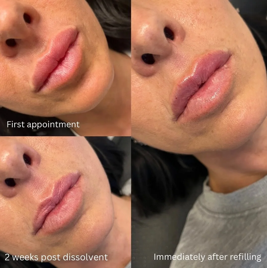 Dissolving isn’t always a bad thing. Clients who are consistent with their filler may end up eventually having to dissolve and start fresh at some point in their injectables journey. 
This lovely client came to me having had her lips filled el