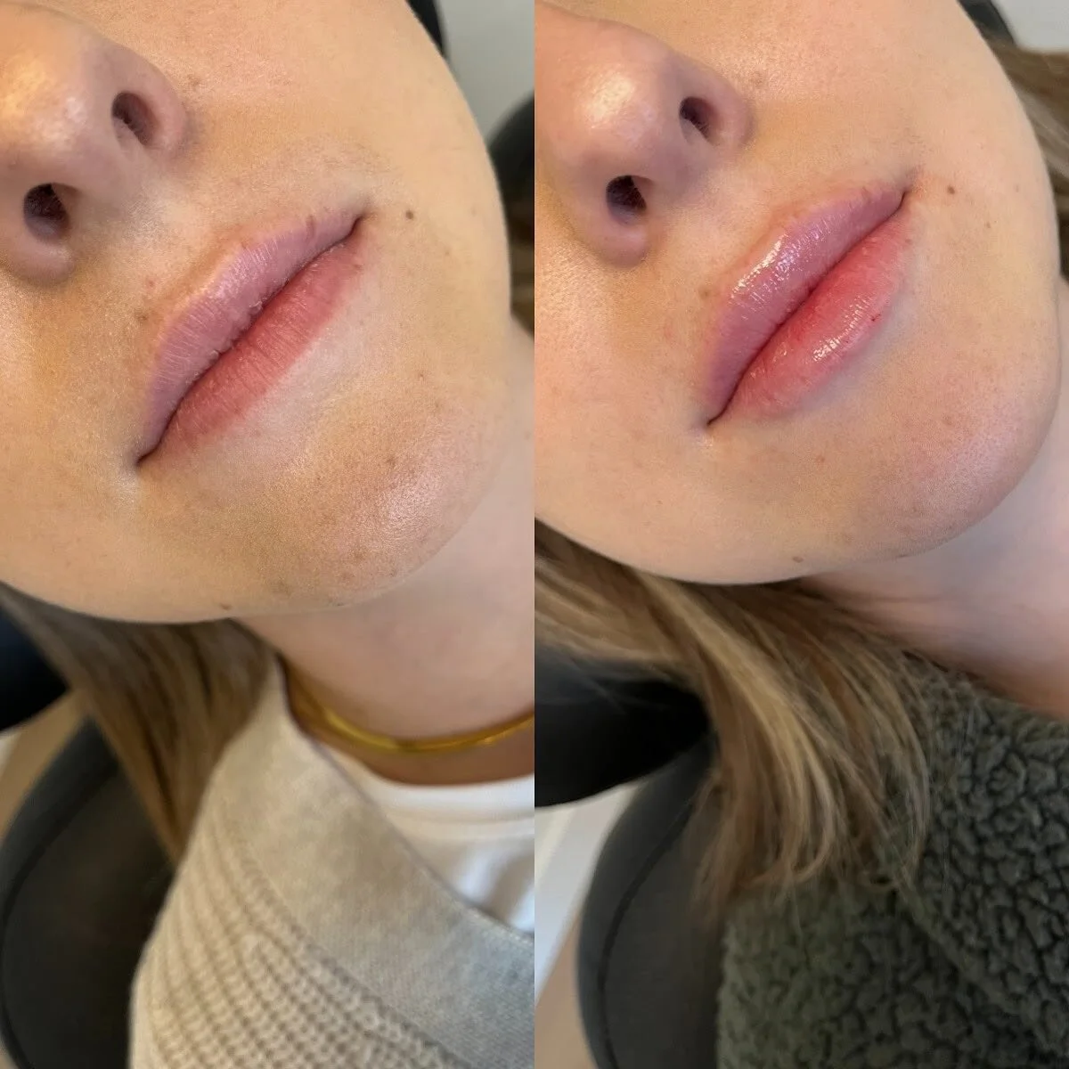 LIPS
π Product - 1/2 syringe - Restylane Kysse
π³ Pain level - 3/10 with numbing cream
β° Length of appointment - 30-45 minutes
β¨ Duration of product - 6-9 months
π Common side effects - bruising, swelling, discomfort 
πLocation - Franks by Frida