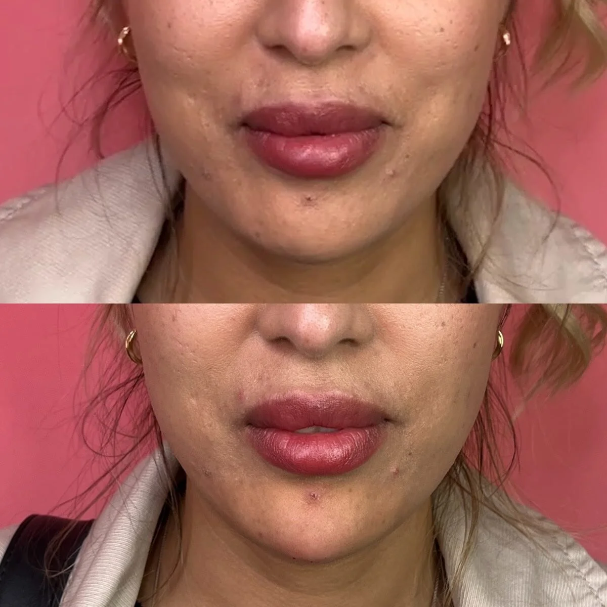 CHIN 
This beauty wanted to add more of a “point” to her chin to give her face more of an elongated appearance
π Product - Teosyal Ultra Deep - 1/2 syringe
π³ Pain level - 3/10
β° Length of appointment - 45 minutes
β¨ Duration of product