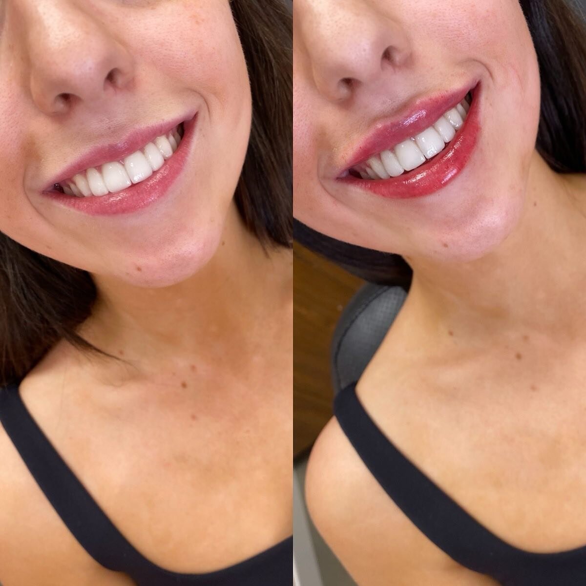 Entering her &ldquo;juicy lip&rdquo; era 💘

Such a fun set of lippies with such a fun gal! 

.

 💉 Product: full syringe Revanesse Outline
⏰ Appointment: 30-45 min
🌈 Booking: Call 403-719-7277, book online using the Vagaro app, or DM me! 

#frida#