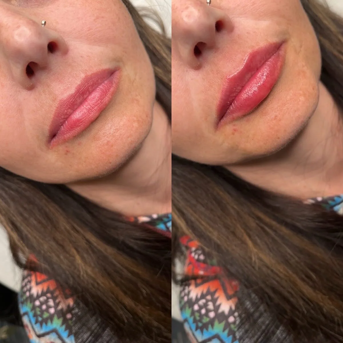 LIPS
π Product - 1/2 syringe - Restylane Kysse
π³ Pain level - 3/10 with numbing cream
β° Length of appointment - 30-45 minutes
β¨ Duration of product - 6-9 months
π Common side effects - bruising, swelling, discomfort 
πLocation - Franks by Frida