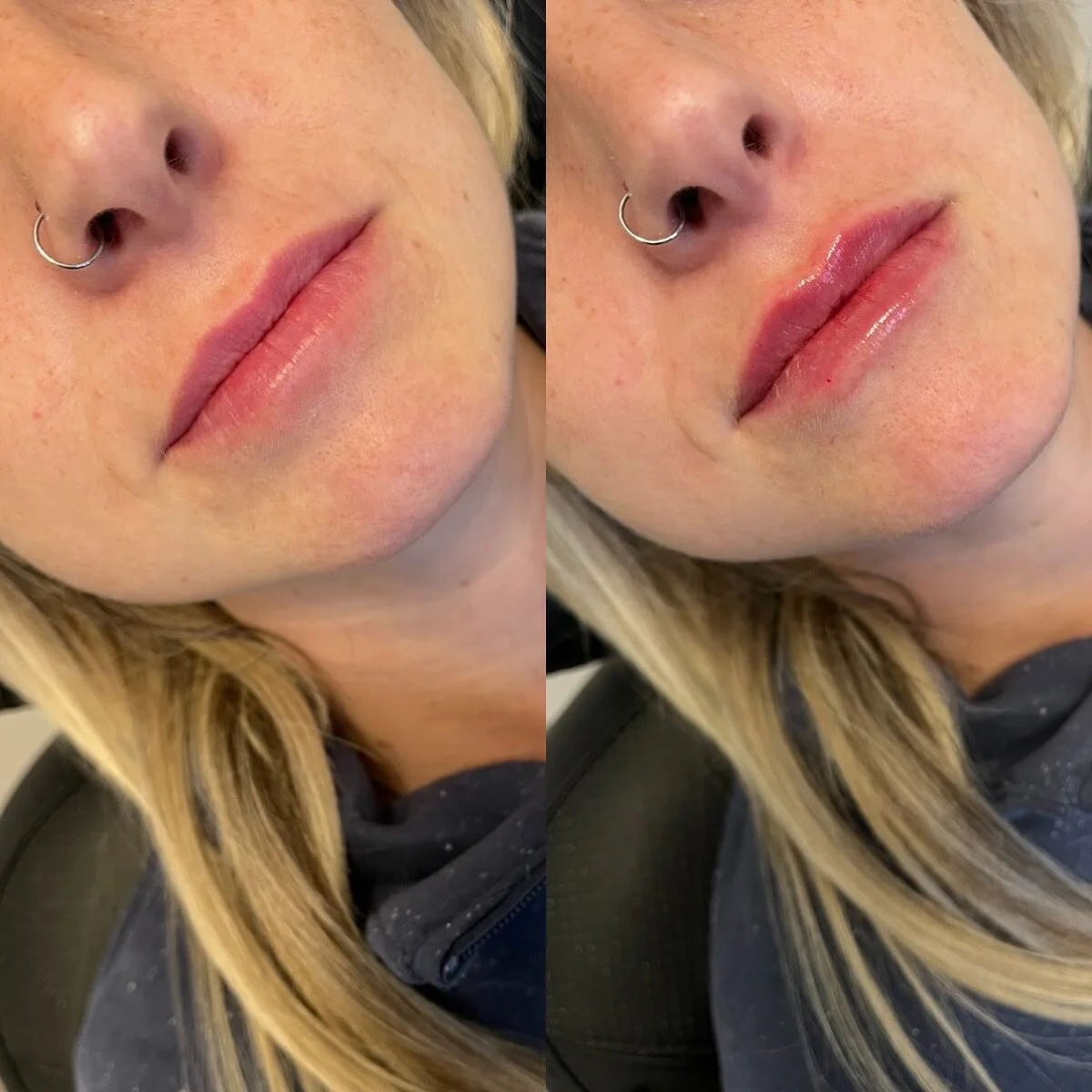 LIPS
π Product - 1/2 syringe - Restylane Kysse
π³ Pain level - 3/10 with numbing cream
β° Length of appointment - 30-45 minutes
β¨ Duration of product - 6-9 months
π Common side effects - bruising, swelling, discomfort 
πLocation - Franks by Frida
