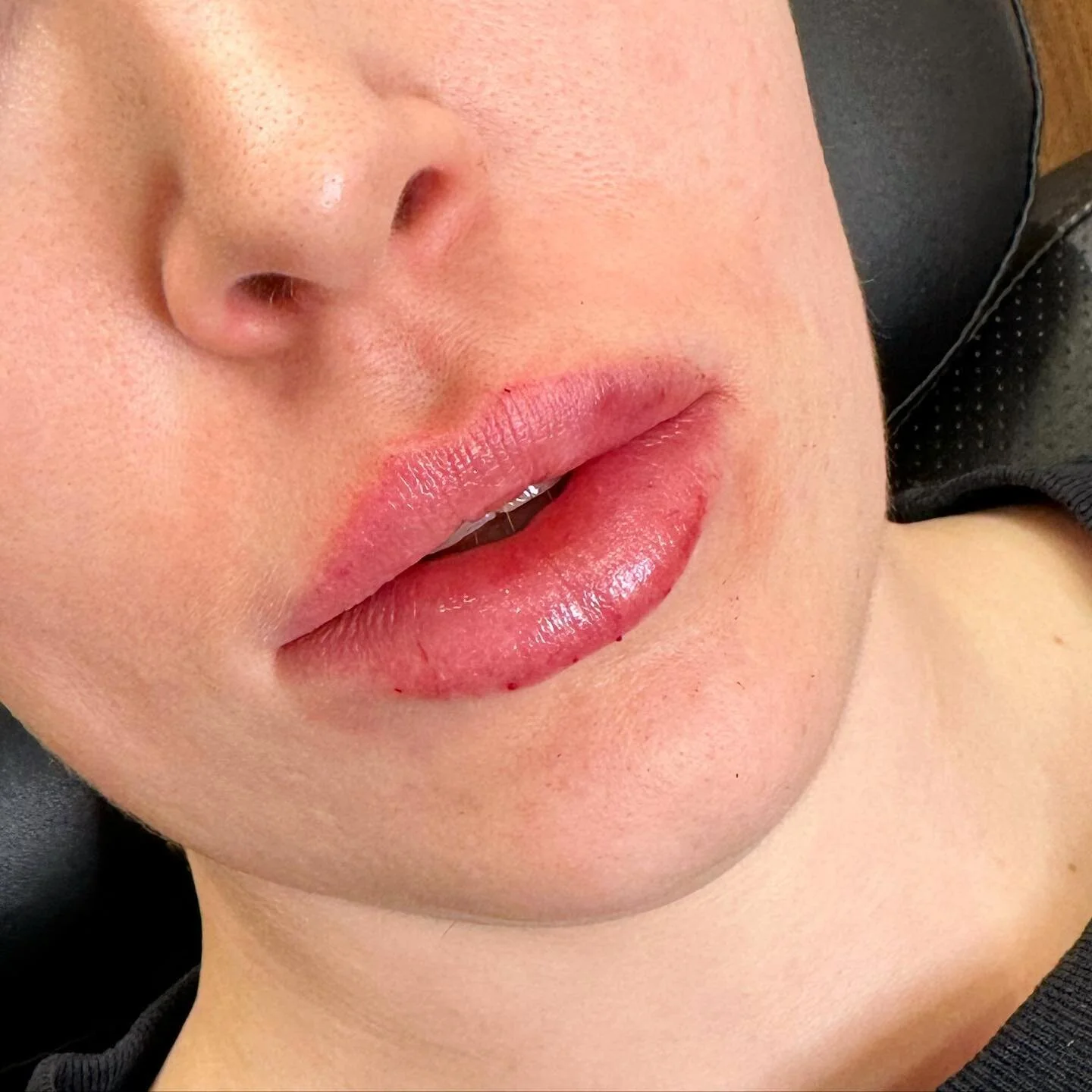 1/2 syringe restylane kysse for a perfect pout ๐
.
.
.
#yyc #nurseinjector #wearefranks #fridabeautybar #botox #fillers #lipfiller #restylanekysse