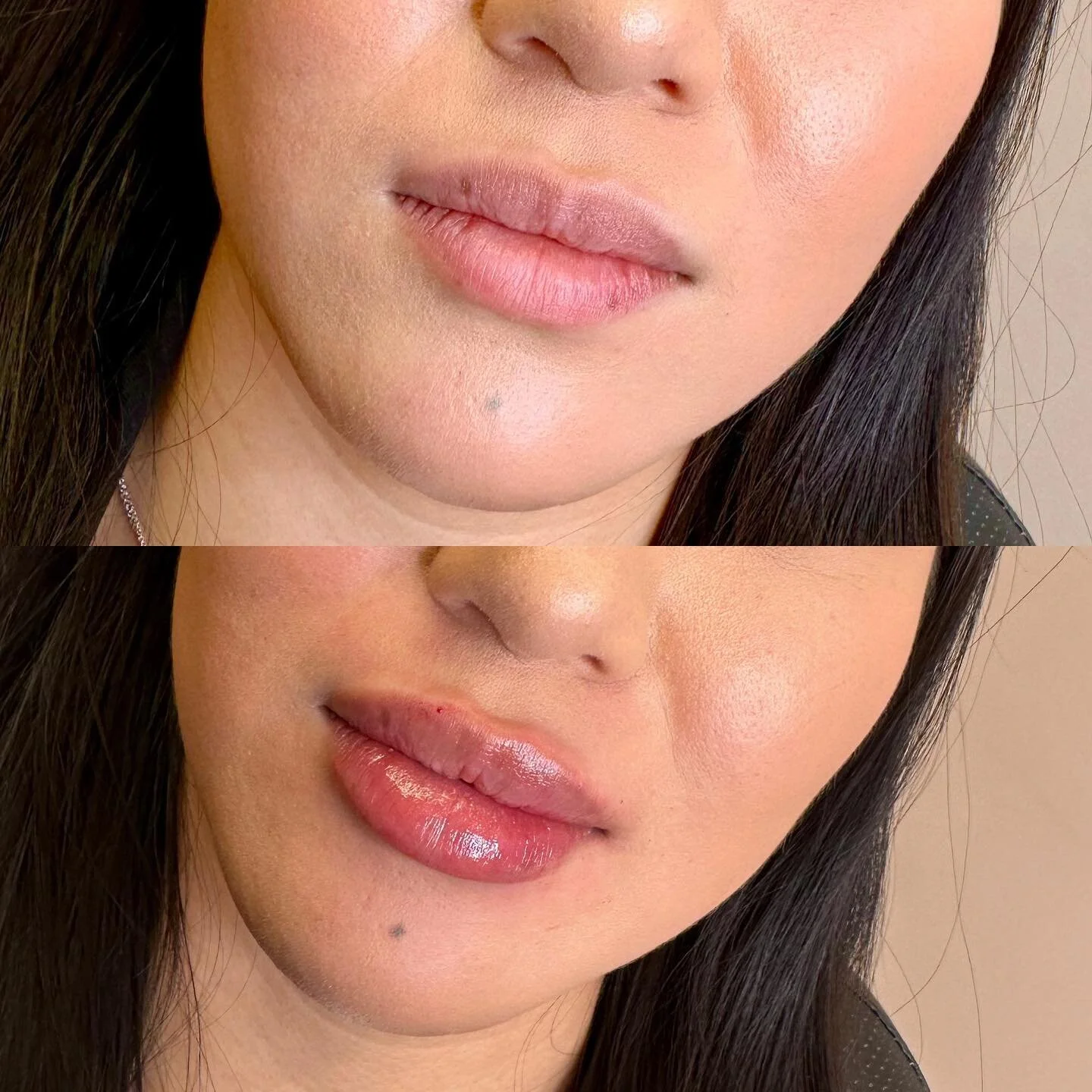 A full syringe for this gals first time getting lip filler. ๐
๐ Product: Restylane Kysse 
โฐ Appointment length: 30-45 minutes
๐คBooking: 403-719-7277 or through Vagaro 
.
.
.
#yyc #nurseinjector #wearefranks #fridabeautybar #botox #fillers #lips