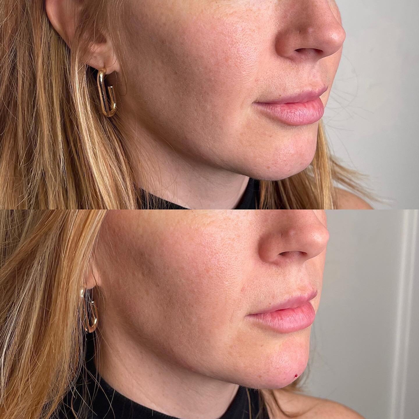CHIN FILLER 💉 

Chin filler to add some projection to the beautiful @frida.megs 🫶🏽

✖️Product: Teosyal Ultradeep
✖️Longevity: 9-12 months 
✖️Appointment Length: 30-45 minutes 
✖️Common Side Effects: swelling/bruising 

&bull;
&bull;
&bull;
&bull; 