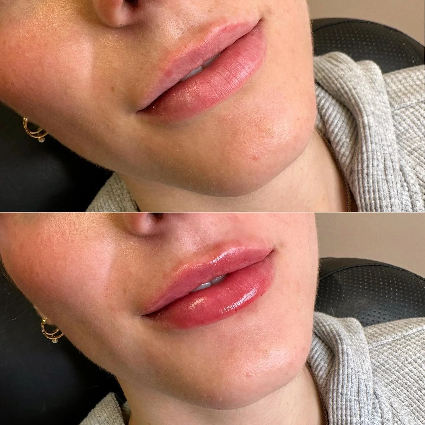 Just a touch extra! ๐ช 
…0.3cc to be exact. 
๐ Product: Revanesse Outline 
โฐ Appointment length: 30-45 minutes
๐คBooking: 403-719-7277 or through Vagaro 
.
.
.
#yyc #nurseinjector #wearefranks #fridabeautybar #botox #fillers #lips #lipfil