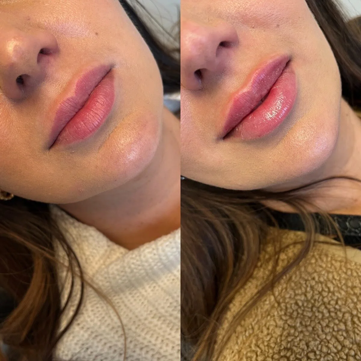 We dissolved some migration above the upper lip and in the “white roll” (as seen in the photo on the left) prior to refilling this babe’s beautiful lips. Dissolving is sometimes necessary to create a sharper vermillion border and mo
