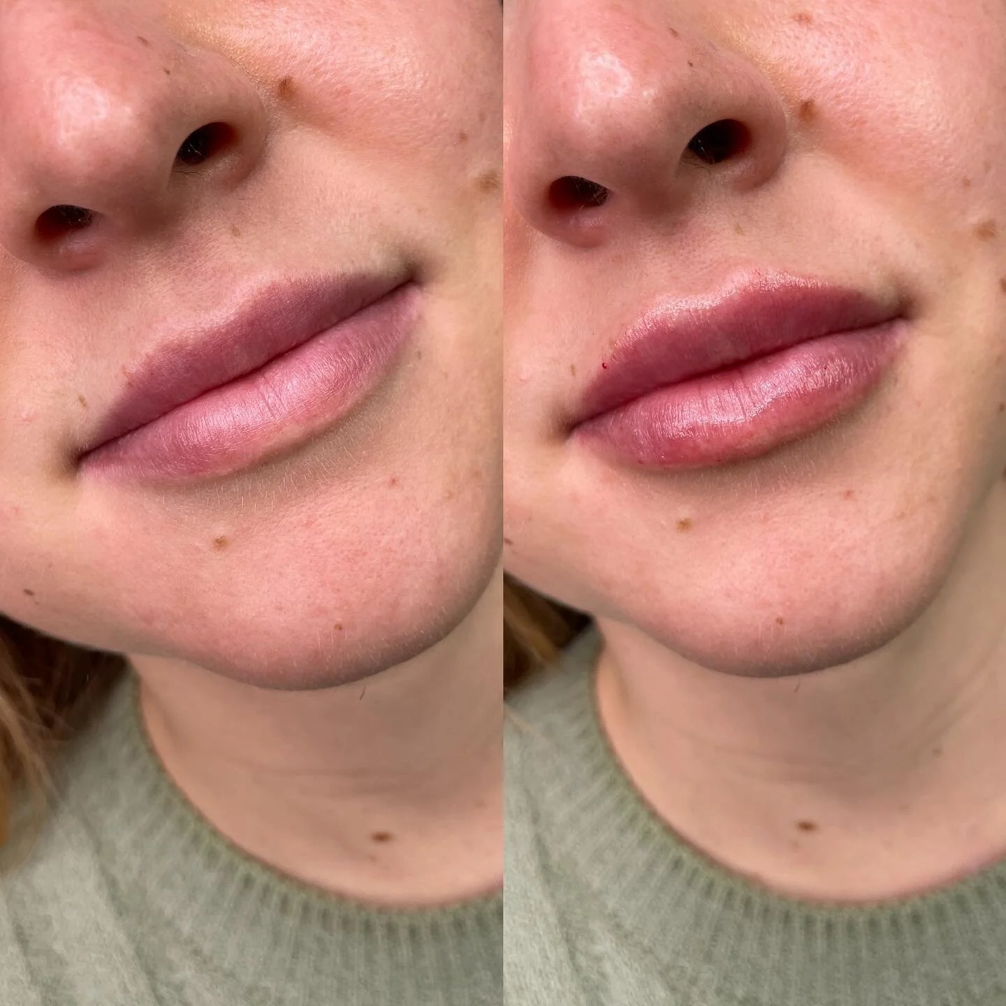 Lips π«¦ππ
•
•
•
•
•
•
With so much love,
Crystal Simms RN π€
#spring #yycbotox #yycliving #yycfillers #yycnurseinjector #lipfiller #summer #yycdysport