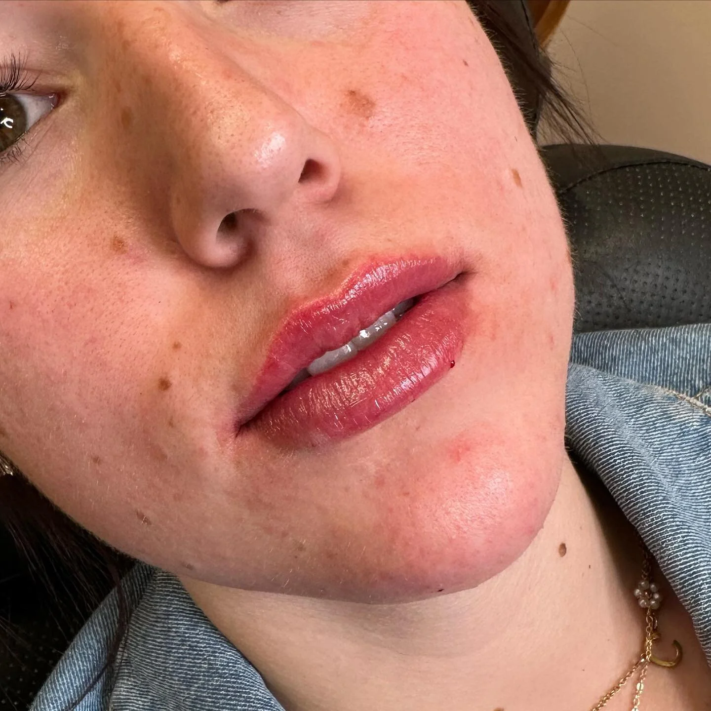 A full syringe split up over two appointments for this client. ๐
The first photo shows immediately after the second appointment (a full syringe total with a little swell). 
โก๏ธSWIPE TO SEE HER LIPS PRIOR TO ANY FILLER!!
***we also added filler to