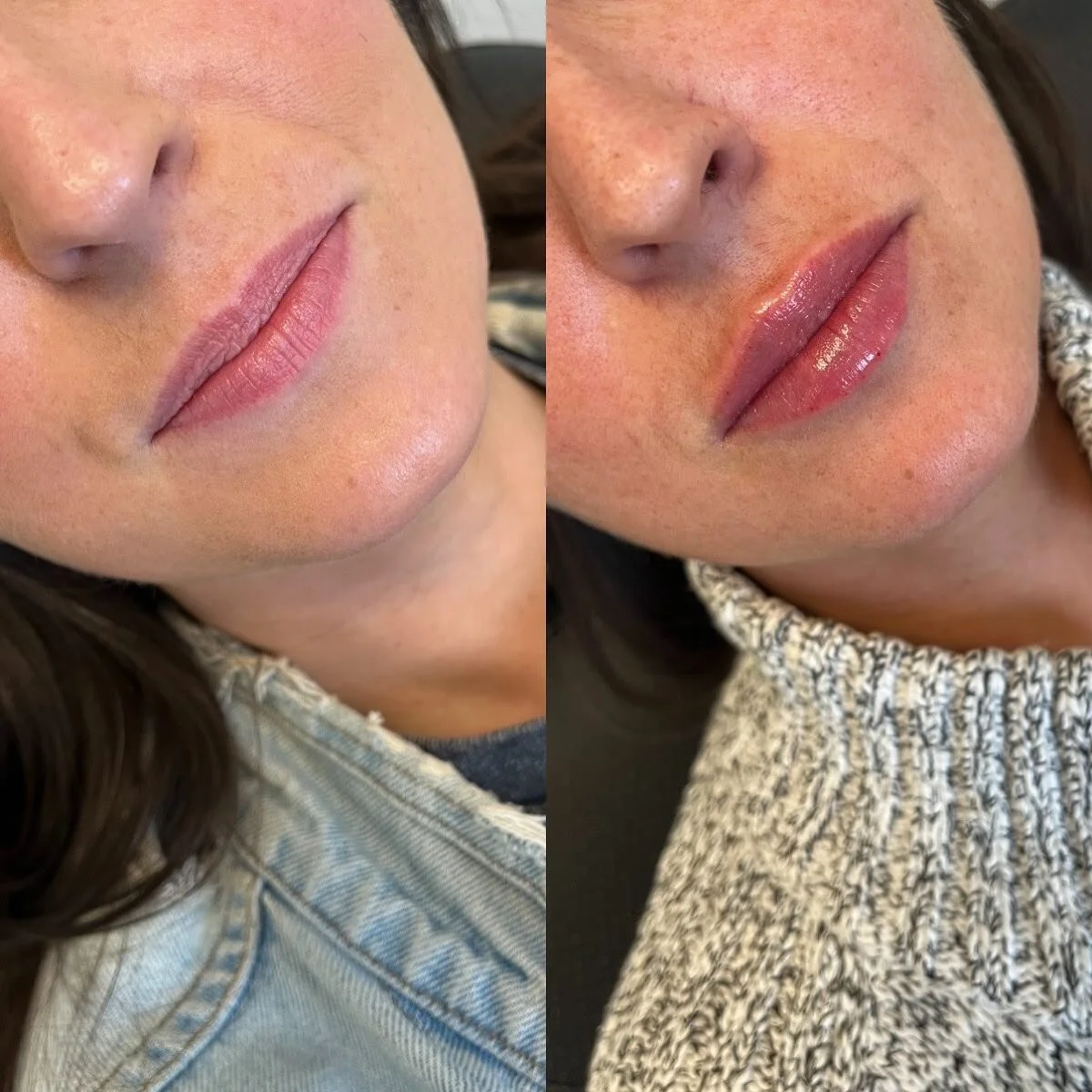 Full syringe spaced out over 2 appointments, injecting 1/2 syringe at a time. 
LIPS
π Product - FULL syringe - Restylane Kysse
π³ Pain level - 3/10 with numbing cream
β° Length of appointment - 30-45 minutes
β¨ Duration of product - 6-9 months
π Co