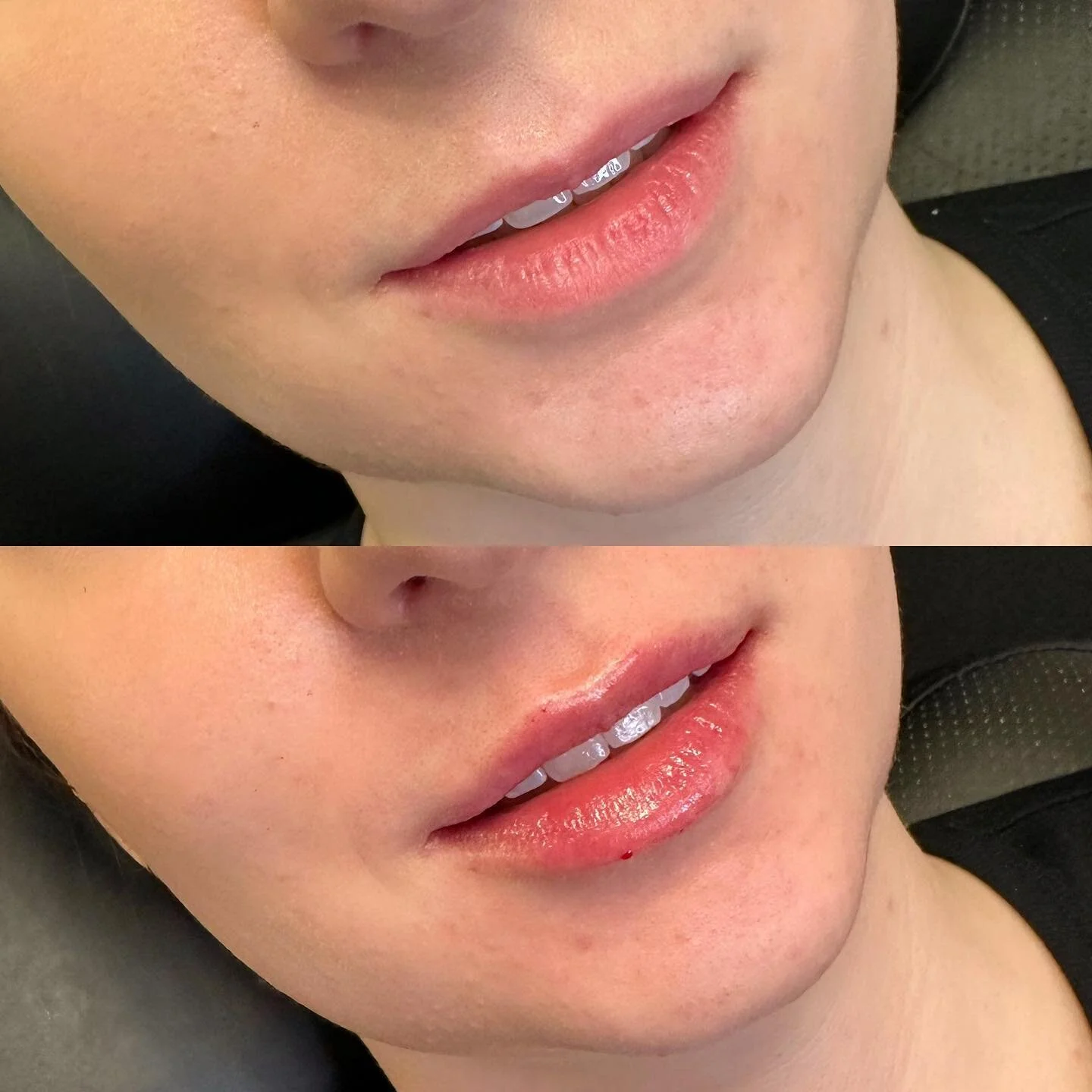 Natural beauties ๐ธ
๐ Product: Restylane Kysse 
โฐ Appointment length: 30-45 minutes
๐คBooking: 403-719-7277 or through Vagaro 
.
.
.
#yyc #nurseinjector #wearefranks #fridabeautybar #botox #fillers #lips #lipfiller #restylane