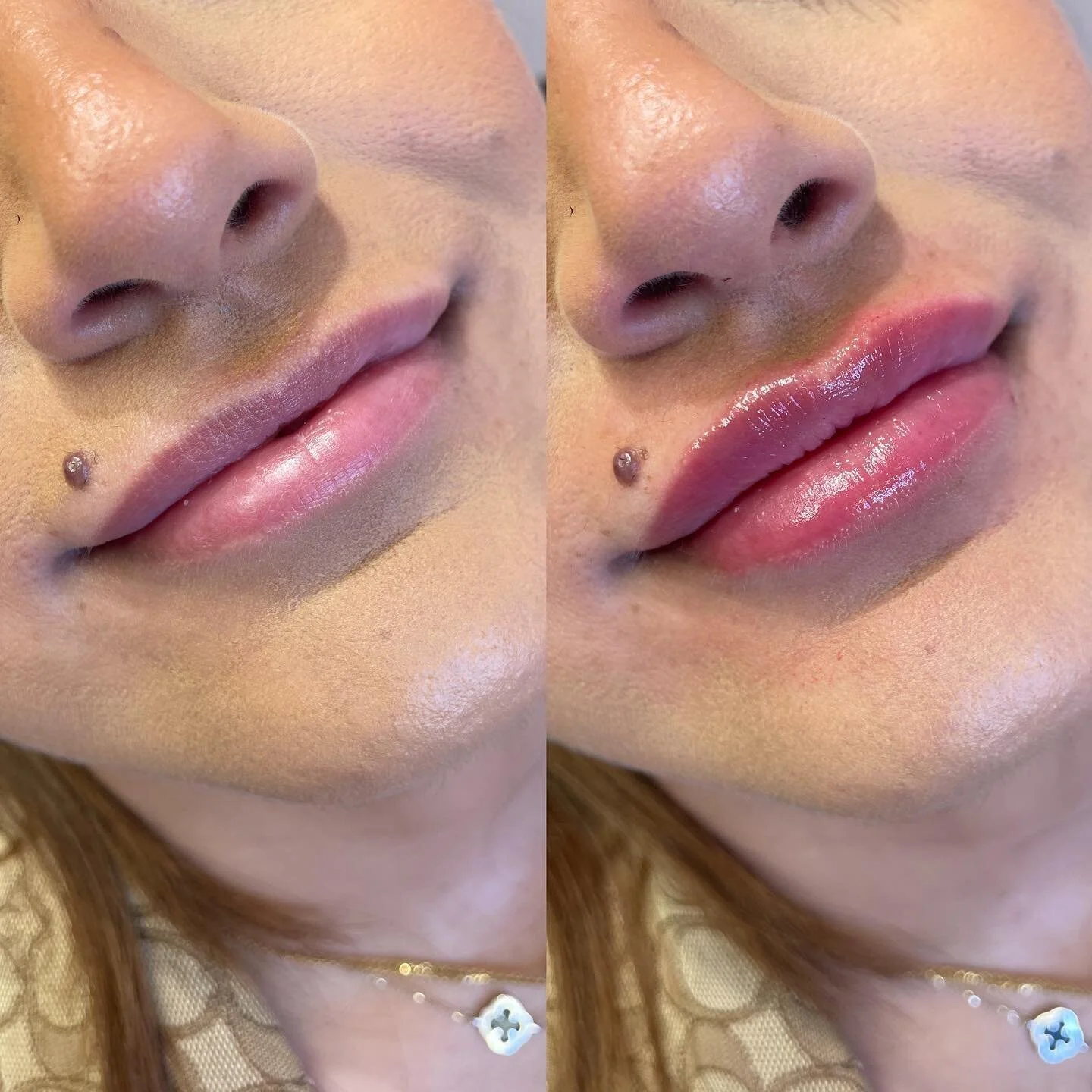 1/2 syringe for a juicy plump π
Before and afters are so important when sharing work to address realistic goals. They are also important during a follow up to see progress. 
Filler can achieve so many of our goals but it does have limits. My lips