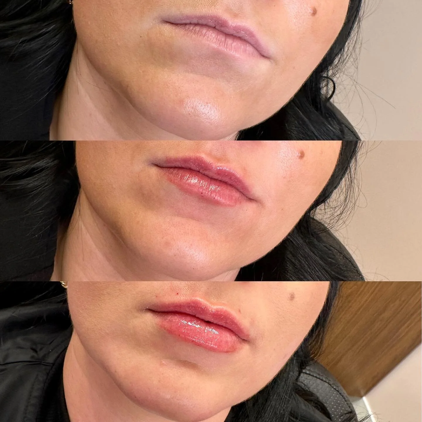 For this client we did a full syringe to her lips over two appointments. ๐
During her second appointment we also added some filler to her pre jowl sulcus creating a softer transition from her jawline to her chin. (Better seen in the second photo)