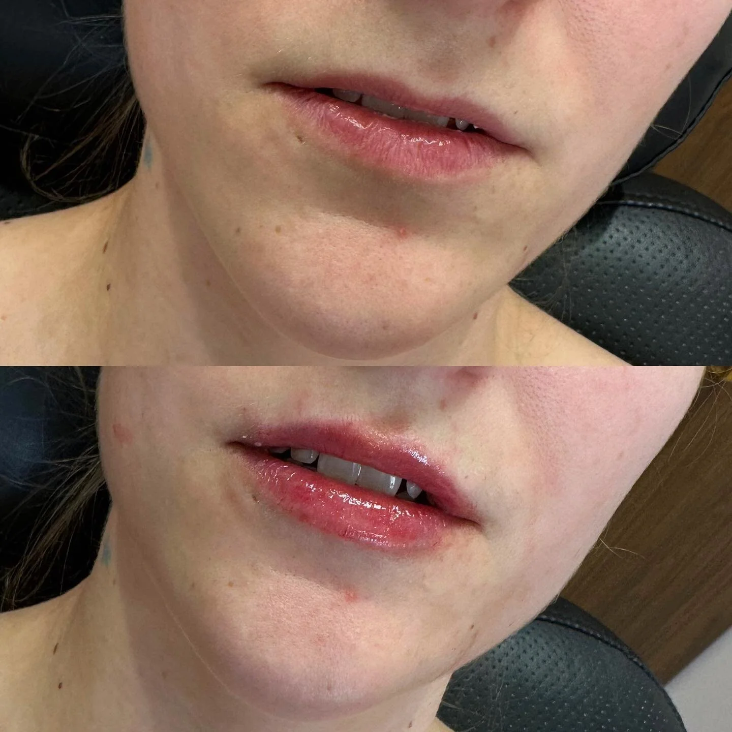 Working on building that top lip? ๐
When your goal is to create a fuller top lip patience and consistency is key. ๐ Putting in a high volume of filler in one sitting with thinner lips is not the way to go and can cause issues like migration, slowi