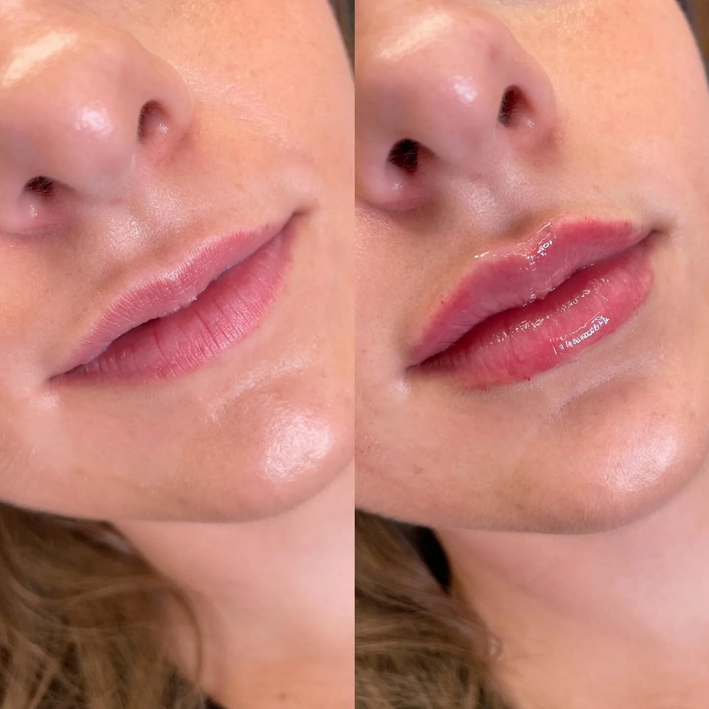 New lips for the summer βοΈπ
π product: 1/2 syringe HA filler
β° duration: 6-12 months 
π© pain: minimal with numbing cream
π common side effects: swelling & bruising
π satisfaction: guaranteed 
•
•
•
•
•
•
With s