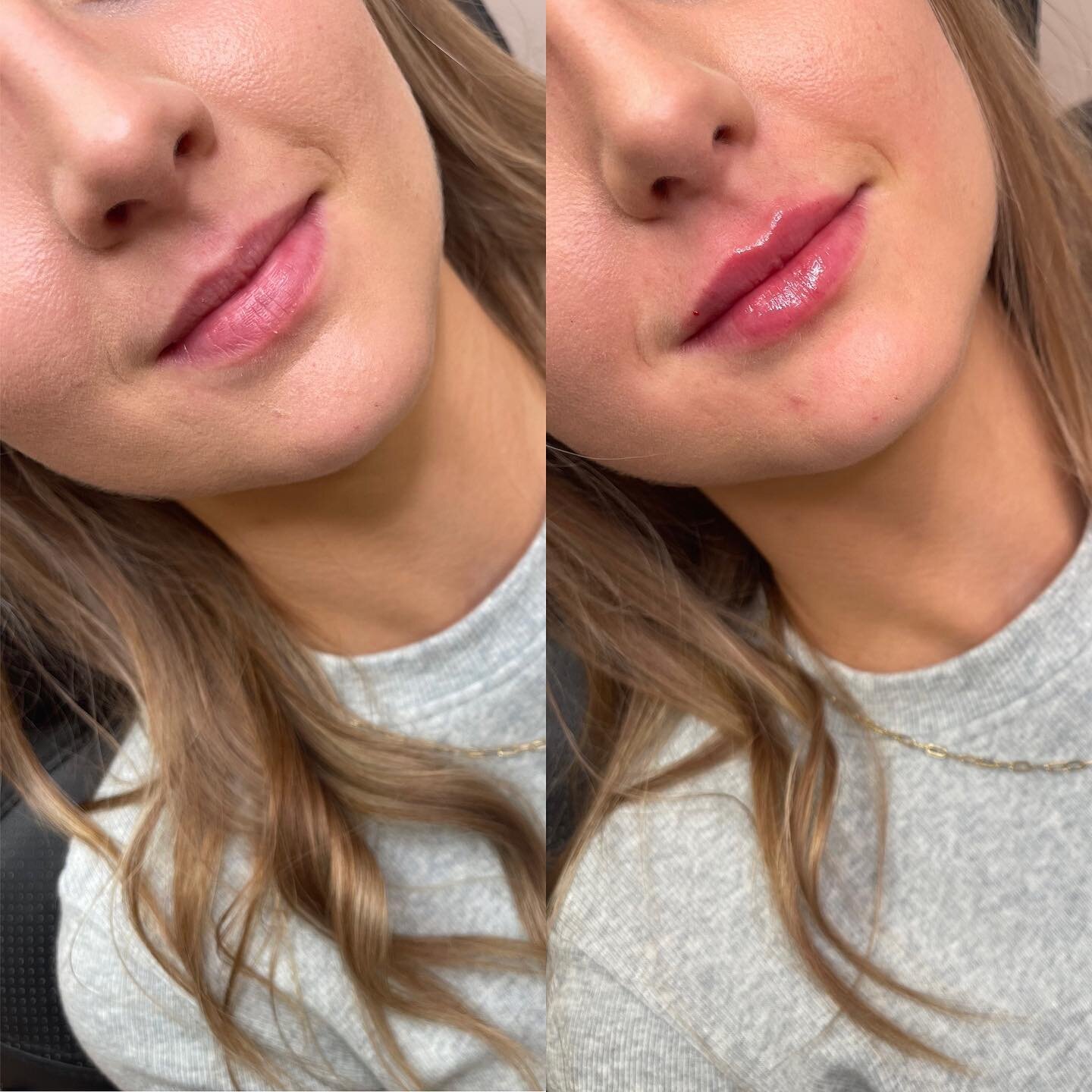 LIP FILLER 💋 

1/2 syringe of lip filler to add some height to the top lip for this first time client! 

✖️Product: Revanesse Outline 
✖️Longevity: 6-9 months 
✖️Appointment Length: 30-45 minutes 
✖️Common Side Effects: swelling/bruising 

&bull;
&b