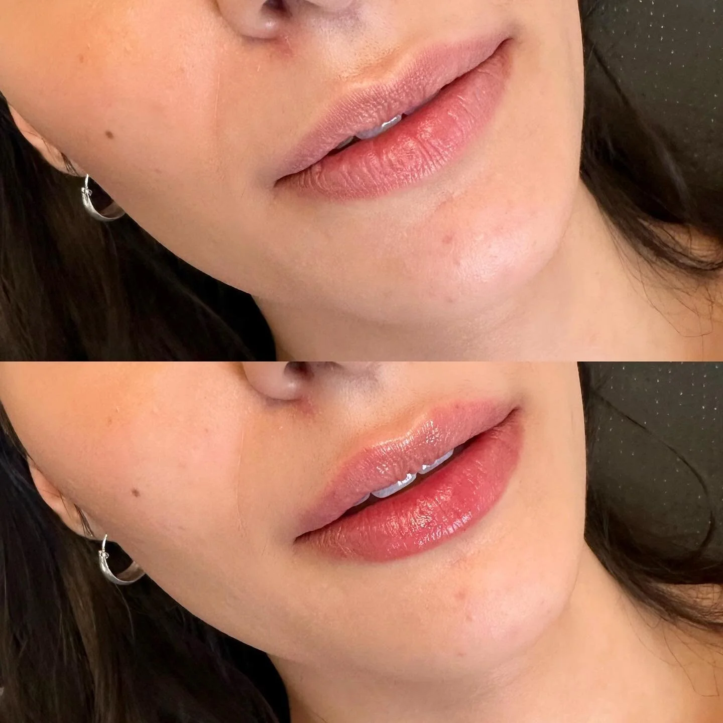Replacing volume and adding hydration using just under half a syringe for this client. ๐
๐ Product: Restylane Kysse 
โฐ Appointment length: 30-45 minutes
๐คBooking: 403-719-7277 or through Vagaro 
.
.
.
#yyc #nurseinjector #wearefranks #fridabeau