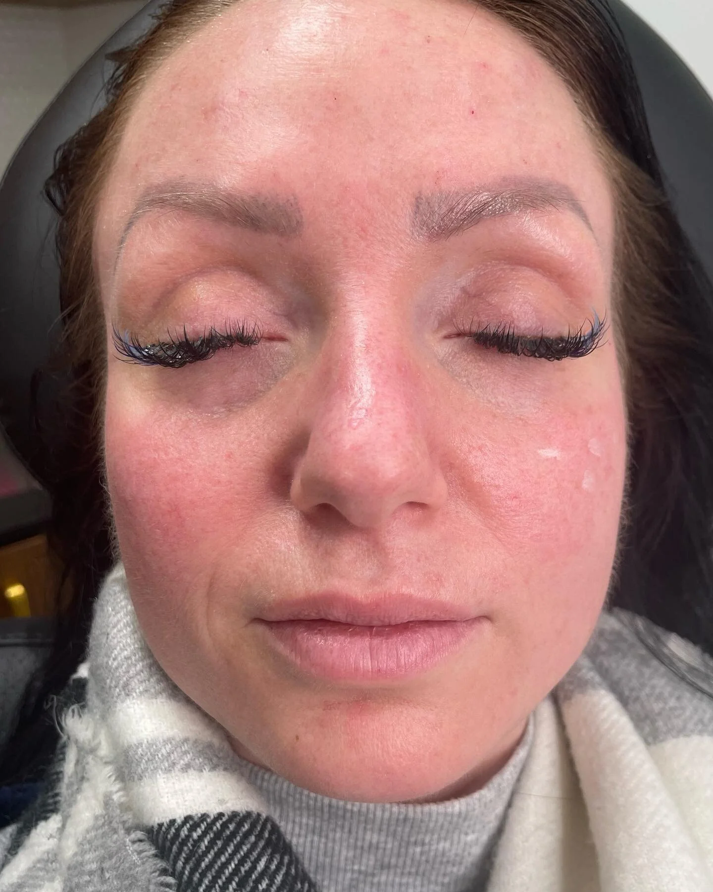 Cheek filler for volume loss ππ
Here, the right cheek is treated and her left is not. You can see the lift in her right cheek and her side profile has volume and is no longer flat. 
Cheek has to be one of my favourite areas to treat as it gives s