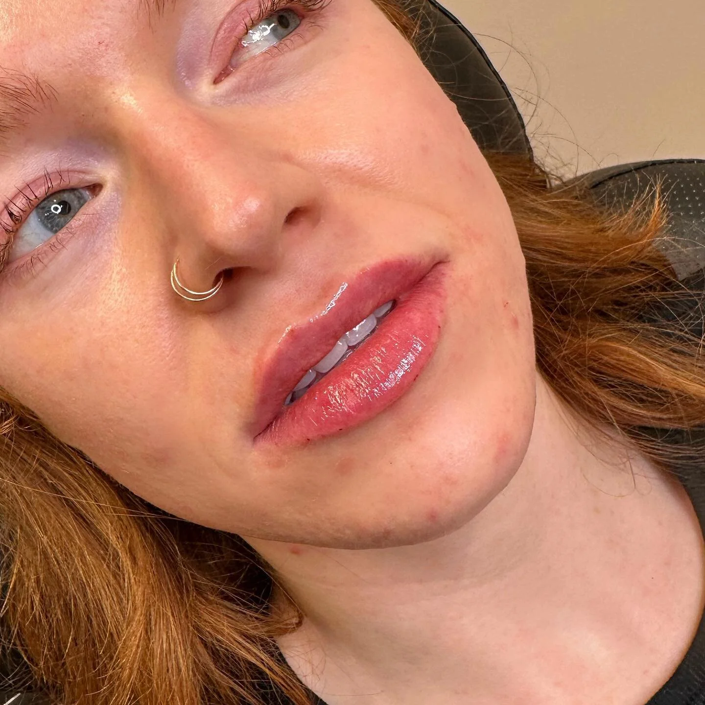 1/2 syringe for this beautiful girl! ๐
Swipe โก๏ธ for before & after. 
๐ Product: Restylane Kysse 
โฐ Appointment length: 30-45 minutes
๐คBooking: 403-719-7277 or through Vagaro 
.
.
.
#yyc #nurseinjector #wearefranks #fridabeautybar #botox #f