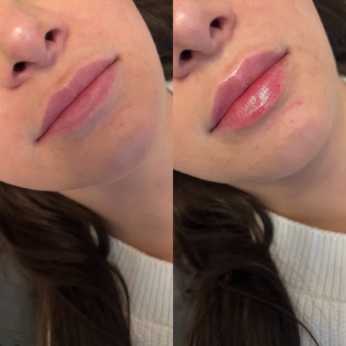 LIPS
π Product - 1/2 syringe - Restylane Kysse
π³ Pain level - 3/10 with numbing cream
β° Length of appointment - 30-45 minutes
β¨ Duration of product - 6-9 months
π Common side effects - bruising, swelling, discomfort 
πLocation - Franks by Frida