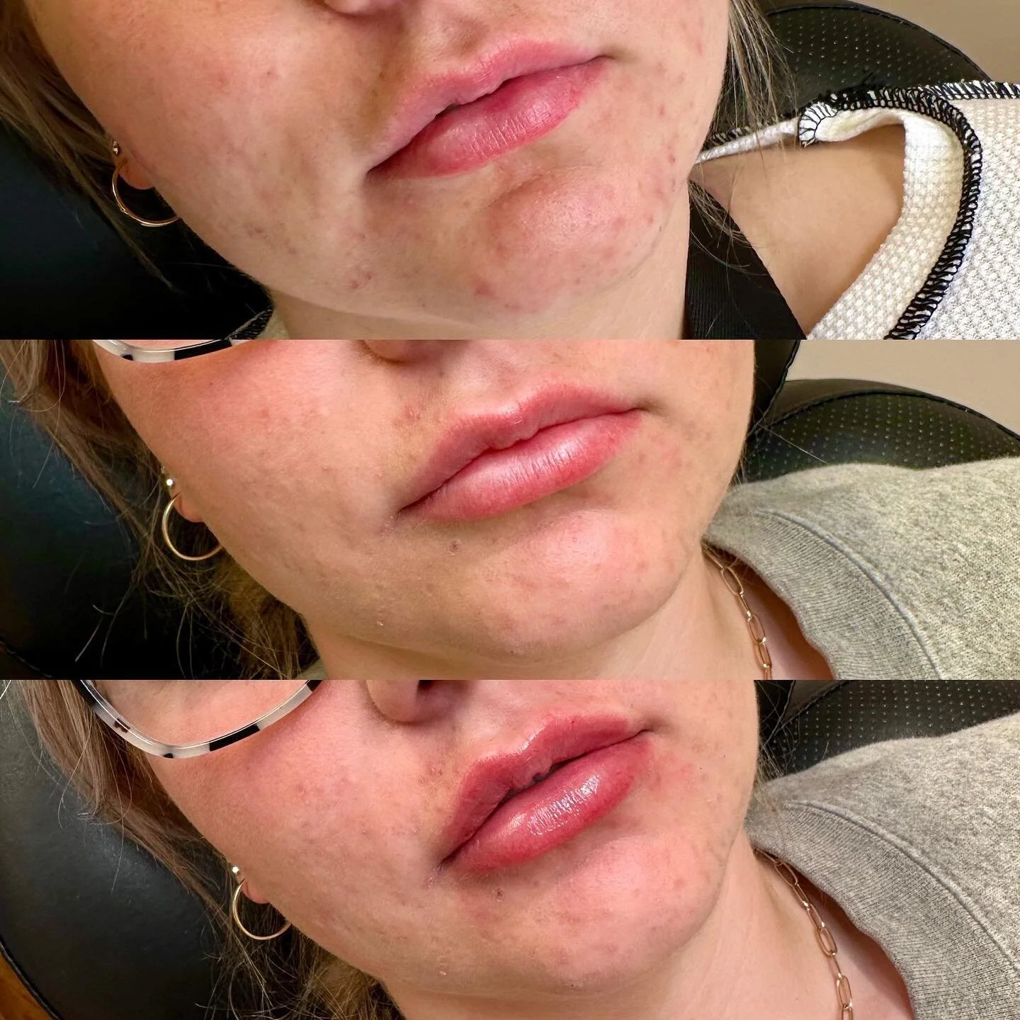 This client wanted to focus on enhancing her top lip! ๐
We decided to do a full syringe over two appointments and added a lip flip to relax the upper lip and help create the appearance of a fuller top lip. 
1) before filler
2) a half syringe fully