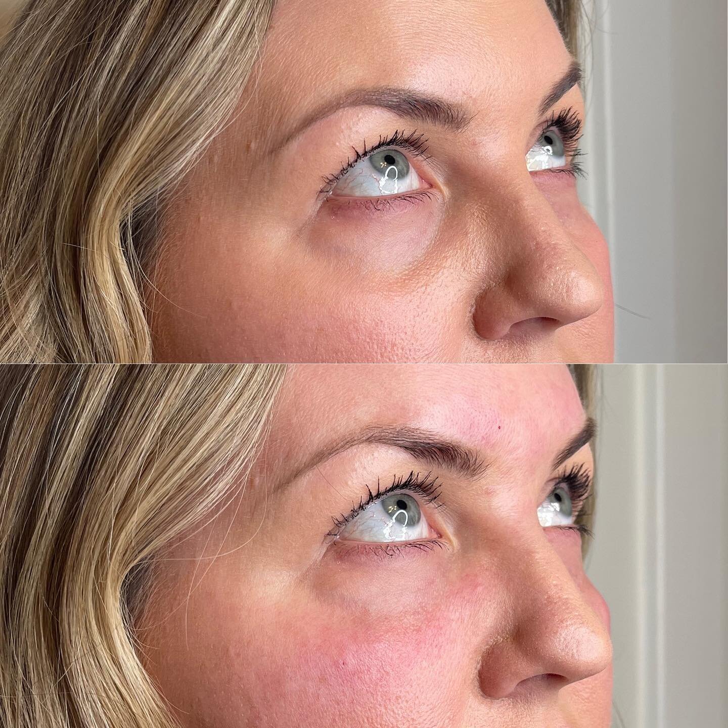 UNDER-EYES 💉 

A little under-eye refresh for my beautiful client! 

✖️Product: Redensity 2 
✖️Longevity: 9-12 months 
✖️Appointment Length: 45 minutes 
✖️Common Side Effects: swelling/bruising 

&bull;
&bull;
&bull;
&bull; 

#yycinjections #botox #