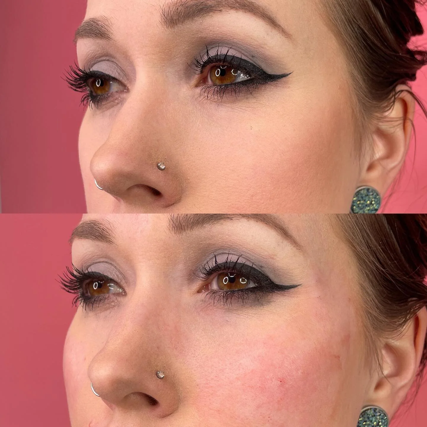 Cheeks π
Swipe for break down
π product: full syringe HA filler
β° duration: 6-12 months 
π© pain: minimal 
π common side effects: swelling & bruising
π satisfaction: guaranteed 
•
•
•
•
•
•
With so much love,
C