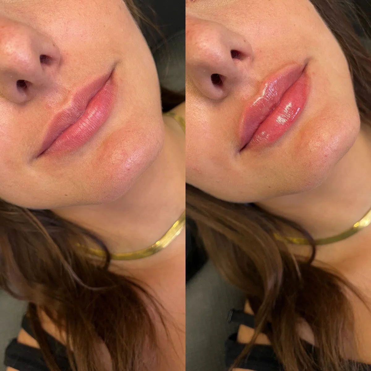 LIPS
π Product - Restylane Kysse
π³ Pain level - 3/10 with numbing cream
β° Length of appointment - 30-45 minutes
β¨ Duration of product - 6-9 months
π Common side effects - bruising, swelling, discomfort 
πLocation - Franks by Frida - Victoria Par