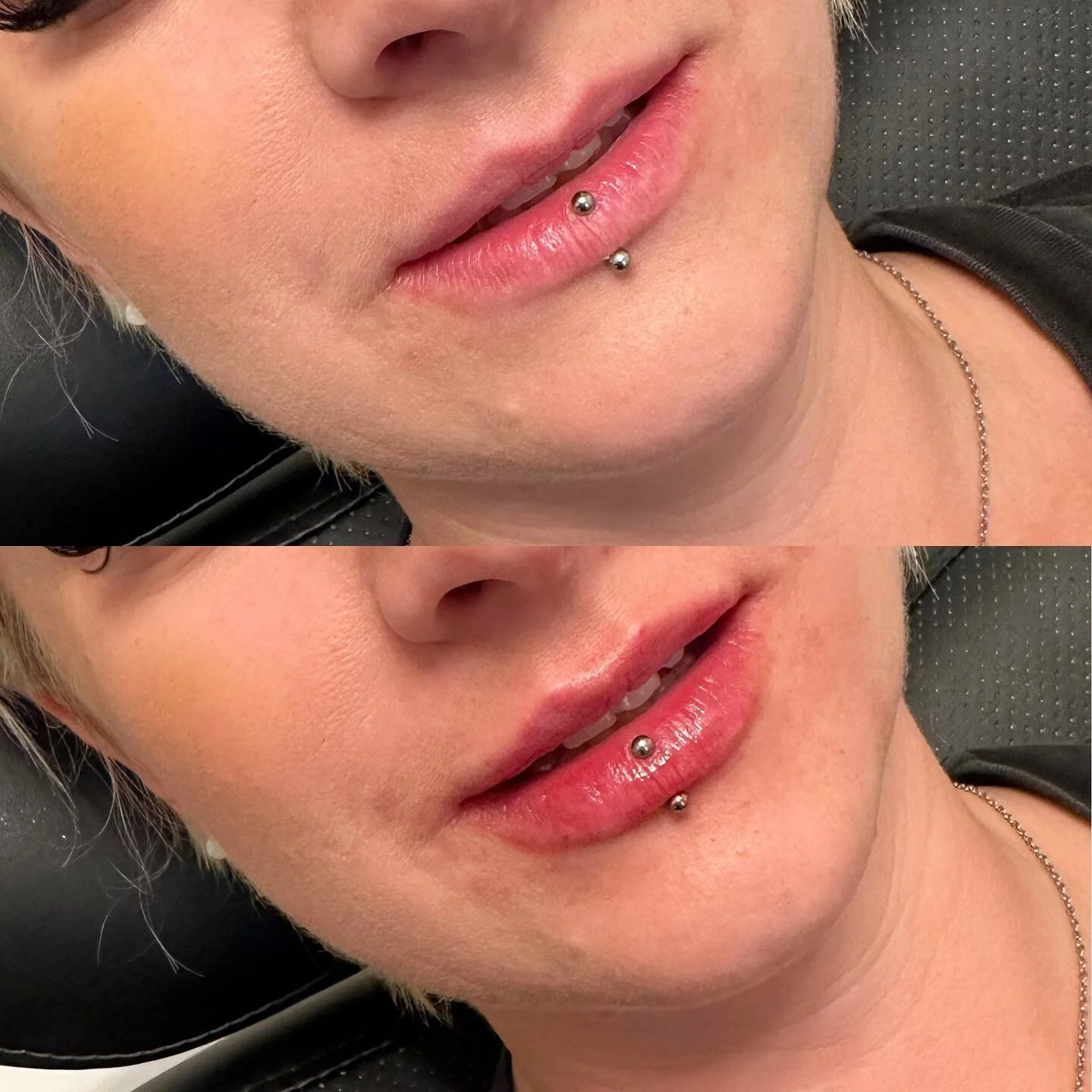 First session with this first time filler client! ๐
We used half a syringe to begin building her top lip and add volume. 
.
.
.