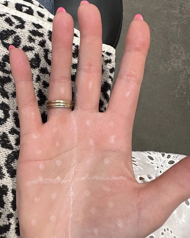 Did you know that we can use Botox for sweaty palms ? . This lady has never felt comfortable holding hands and this changed her life . She had 50 units in each palm and the cost was covered . Pain level of this procedure with topical anesthetic cream
