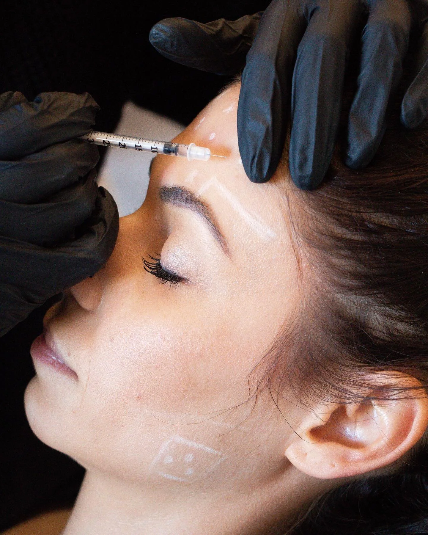 The frequency of Botox treatments varies based on the purpose of the treatment. For cosmetic purposes, Botox injections typically last around 3-4 months, at which point a follow-up session may be scheduled to maintain the desired results. 
π«§ HOW TO