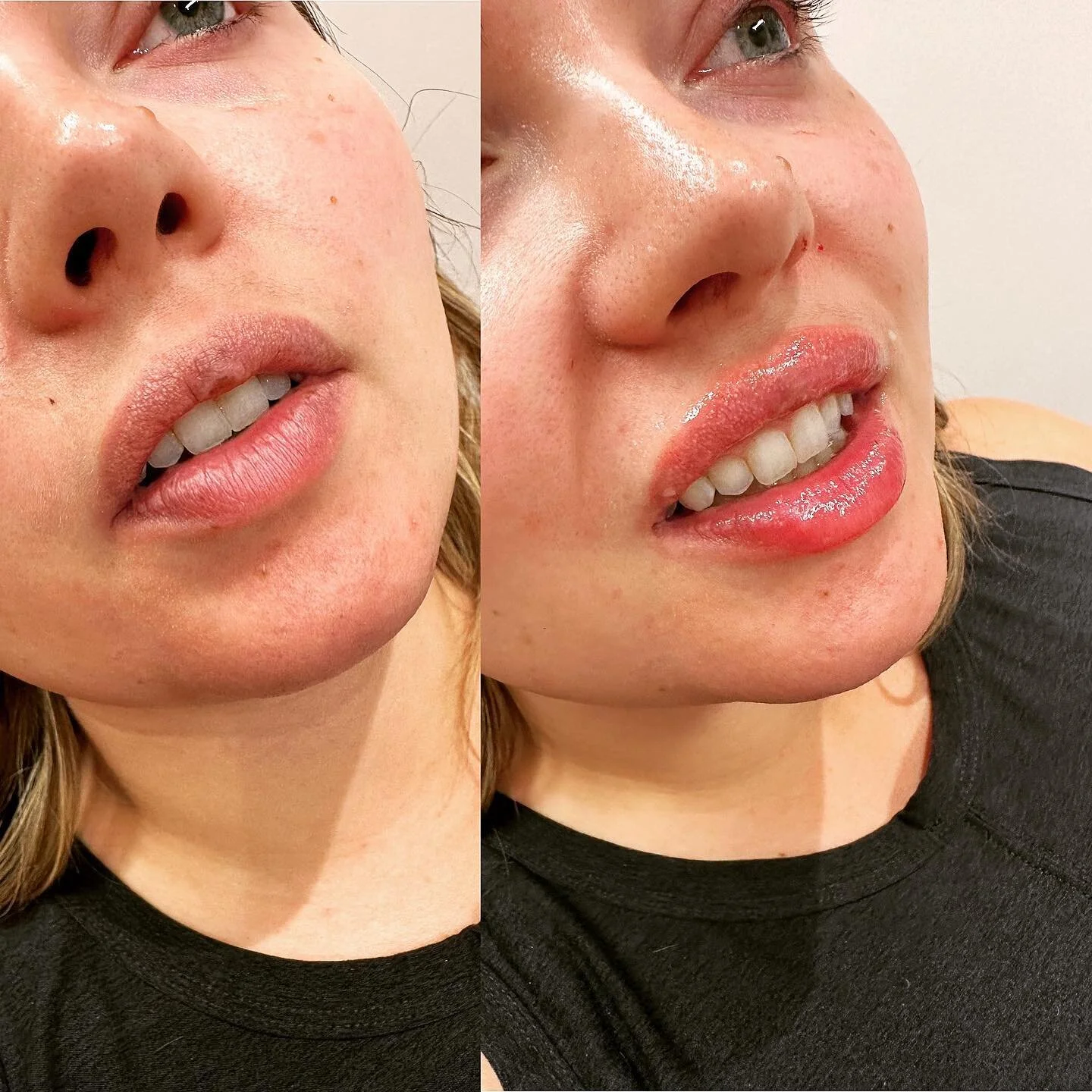 This beauty had half syringe of Restylane Kysse and was happy with the outcome . Just enhanced her cupids bow and lower lip pout .
