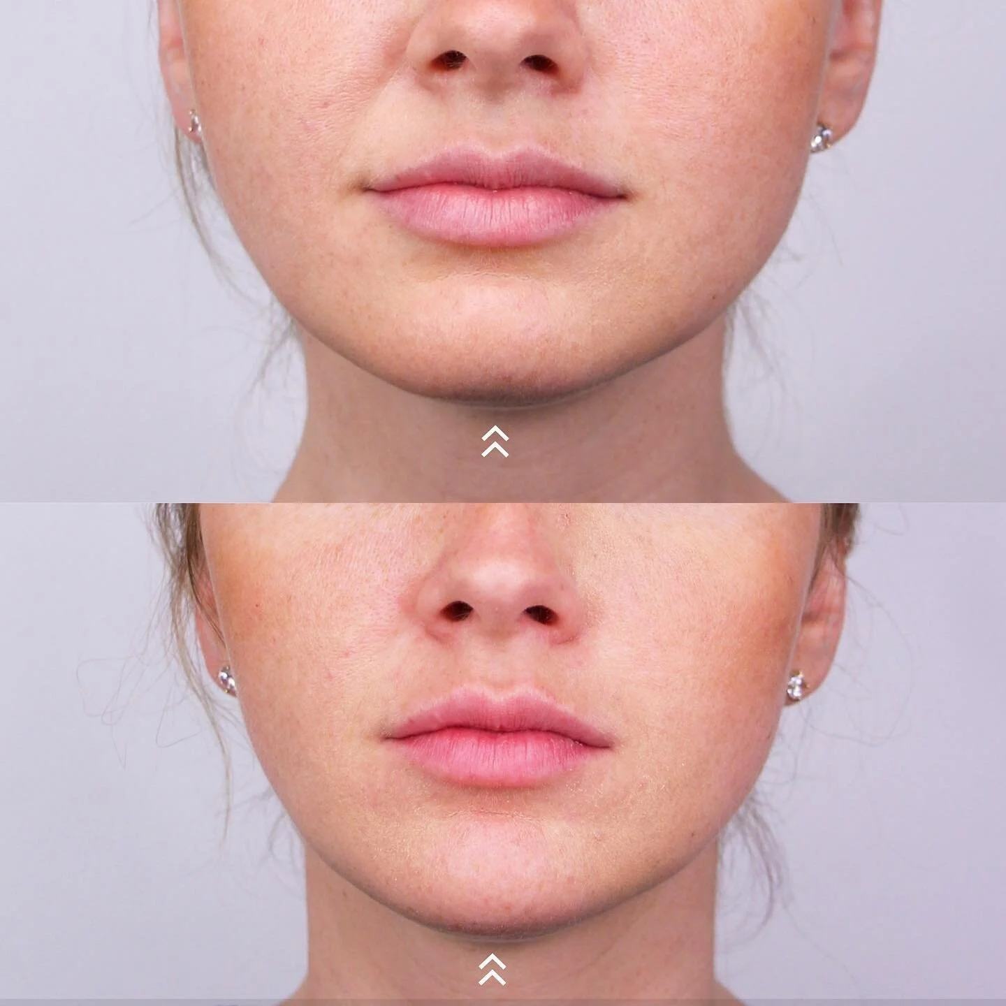 CHIN π
We added a syringe of filler medically to this client to add more length and definition from the front. The chin is one of the central pillars of the face, and if your chin is out of proportion, the rest of your face could look "off.&qu