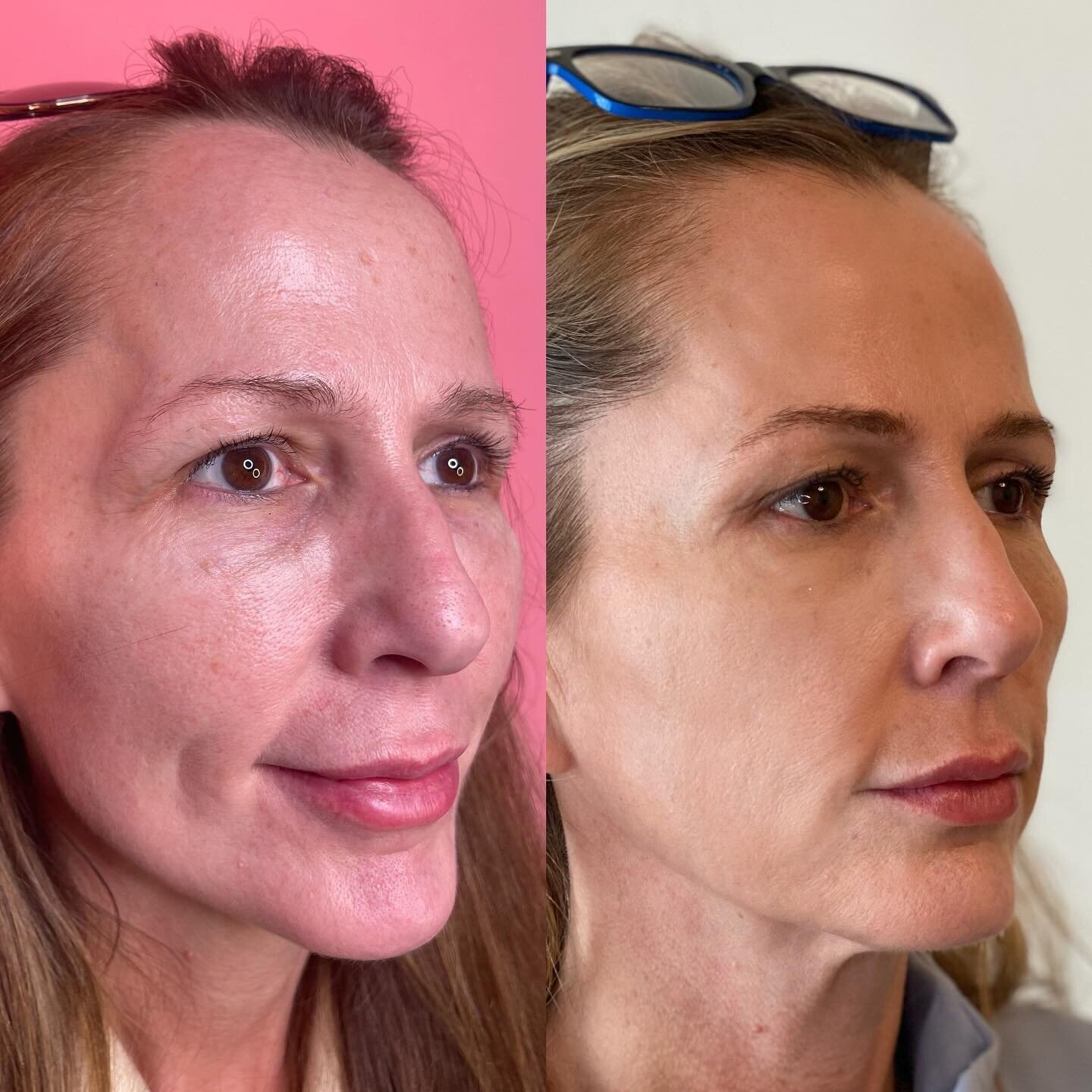 TEMPLES
.
These photos were taken a couple of years apart. The only filler applied was to her temples, and we allowed any residual filler to naturally dissolve. Although there's less overall facial volume in the right picture, it appears more harmoni